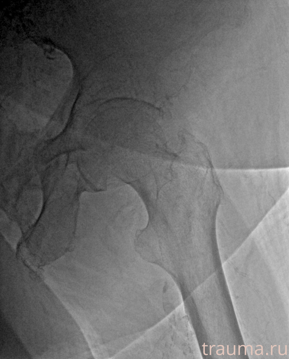 Рентген на дому: по вашему адресу приезжает врач-рентгенолог, травматолог-ортопед с мобильным рентгеновским аппаратом, проводит диагностику травмы или заболевания, делает необходимые рентгенограммы, дает рекомендации по дальнейшему лечению. Получить качественные снимки в домашних условиях возможно благодаря уникальной методике, разработанной МосРентген Центром для института  Склифосовского