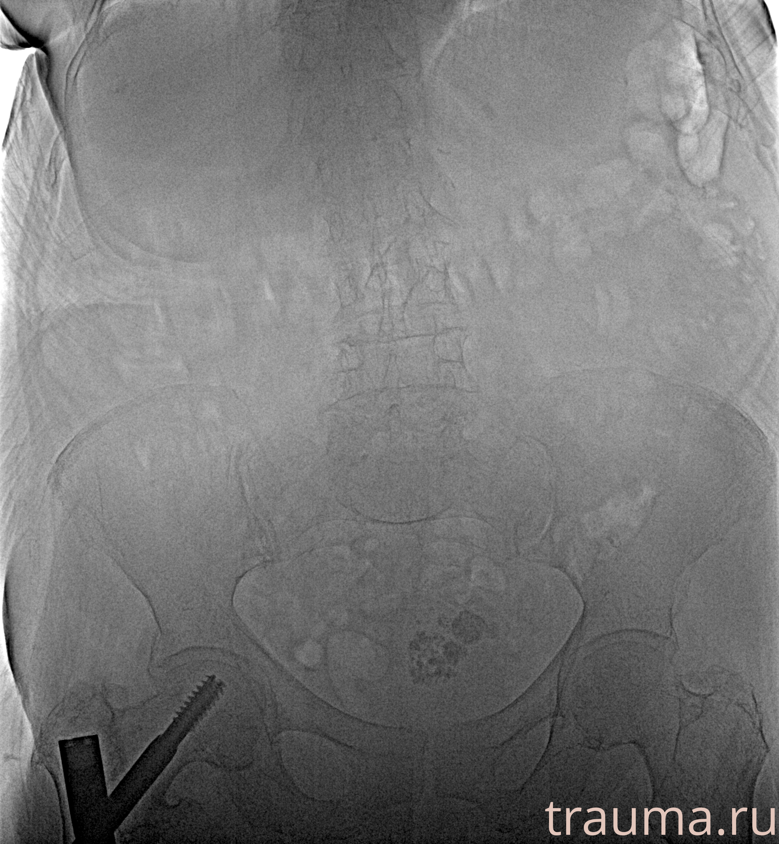 Рентген на дому: по вашему адресу приезжает врач-рентгенолог, травматолог-ортопед с мобильным рентгеновским аппаратом, проводит диагностику травмы или заболевания, делает необходимые рентгенограммы, дает рекомендации по дальнейшему лечению. Получить качественные снимки в домашних условиях возможно благодаря уникальной методике, разработанной МосРентген Центром для института  Склифосовского