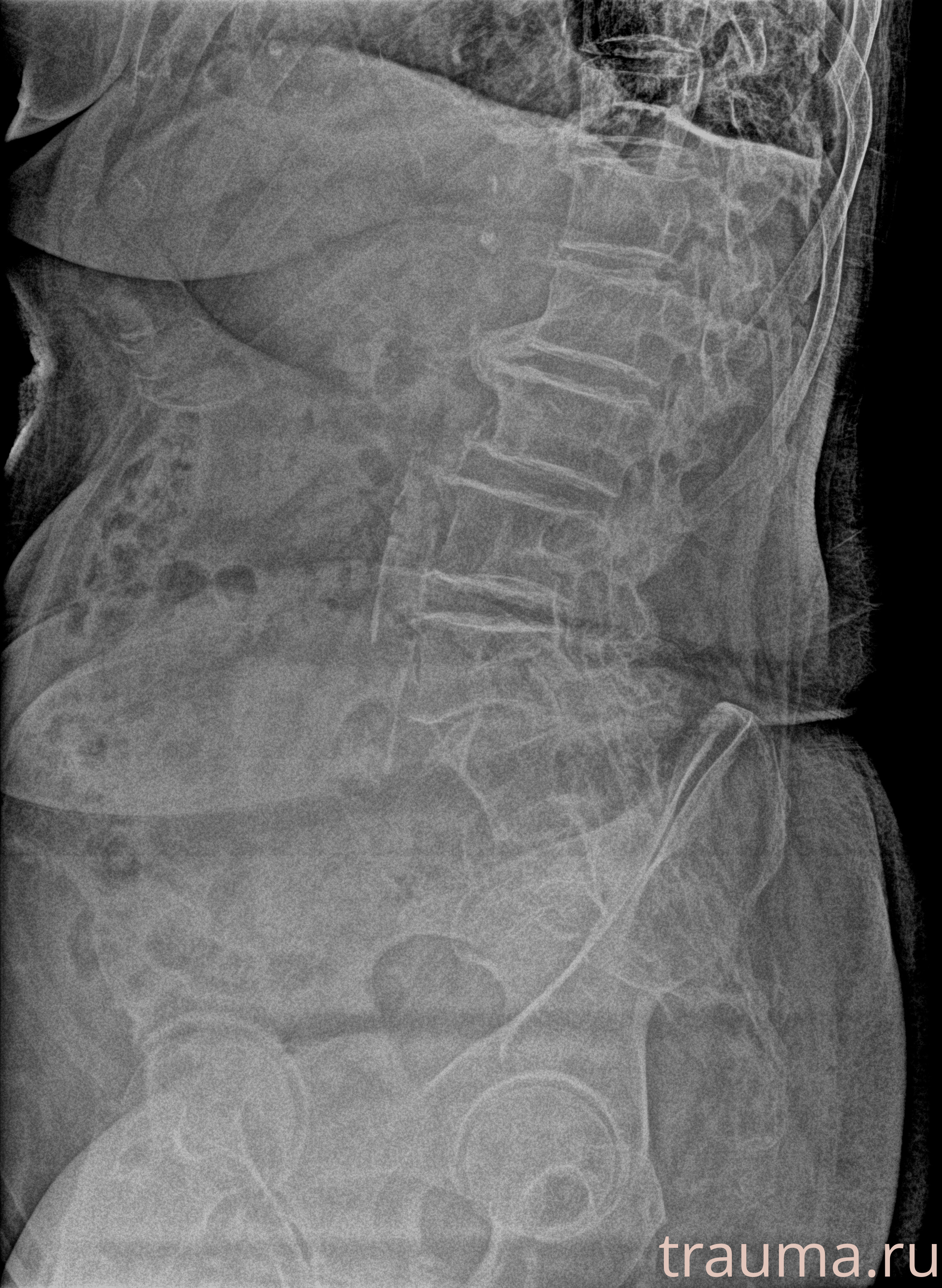 Рентген на дому: по вашему адресу приезжает врач-рентгенолог, травматолог-ортопед с мобильным рентгеновским аппаратом, проводит диагностику травмы или заболевания, делает необходимые рентгенограммы, дает рекомендации по дальнейшему лечению. Получить качественные снимки в домашних условиях возможно благодаря уникальной методике, разработанной МосРентген Центром для института  Склифосовского