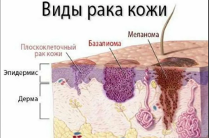 Плоскоклеточный рак кожи Плоскоклеточный рак кожи