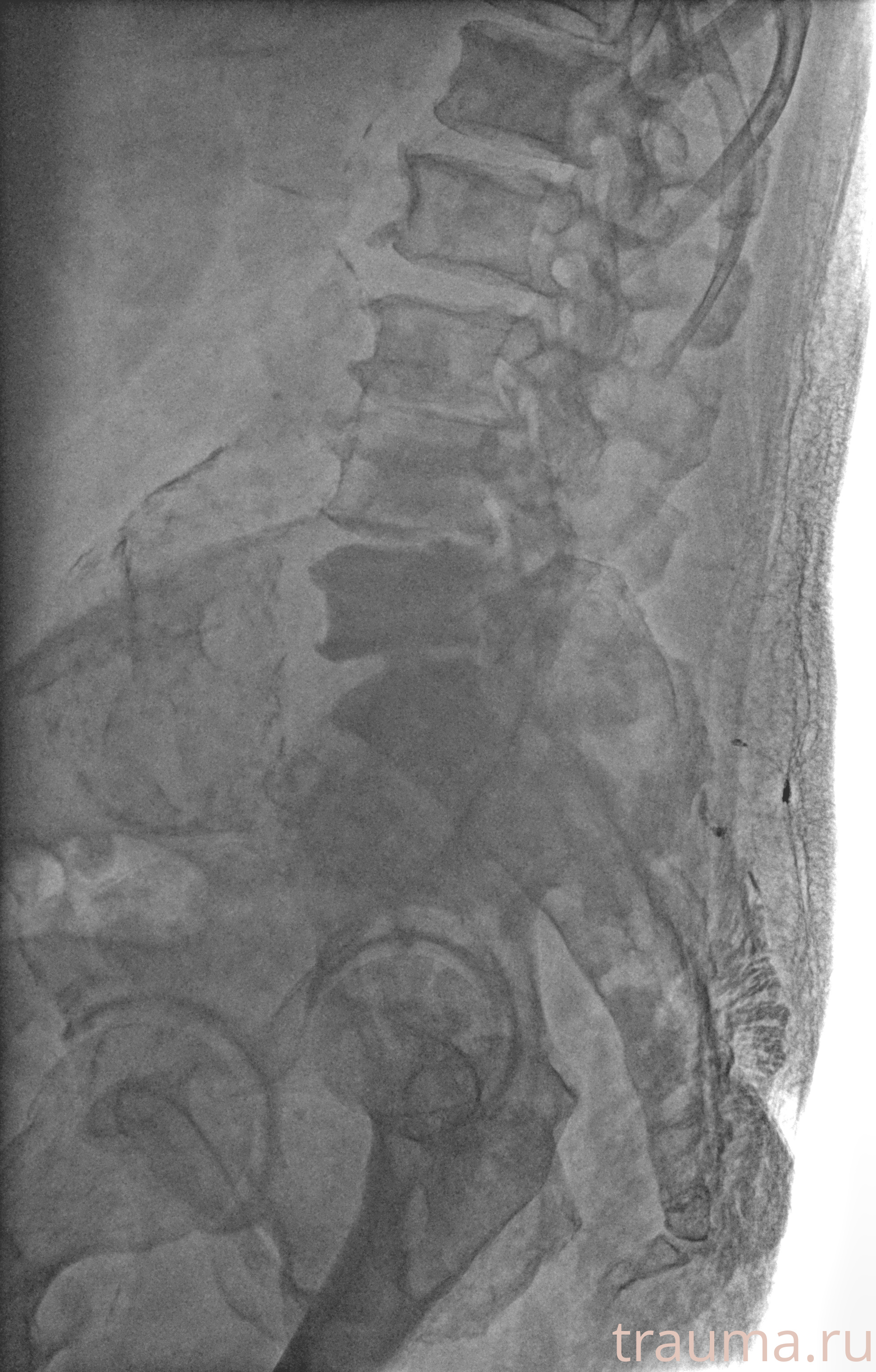 Рентген на дому: по вашему адресу приезжает врач-рентгенолог, травматолог-ортопед с мобильным рентгеновским аппаратом, проводит диагностику травмы или заболевания, делает необходимые рентгенограммы, дает рекомендации по дальнейшему лечению. Получить качественные снимки в домашних условиях возможно благодаря уникальной методике, разработанной МосРентген Центром для института  Склифосовского