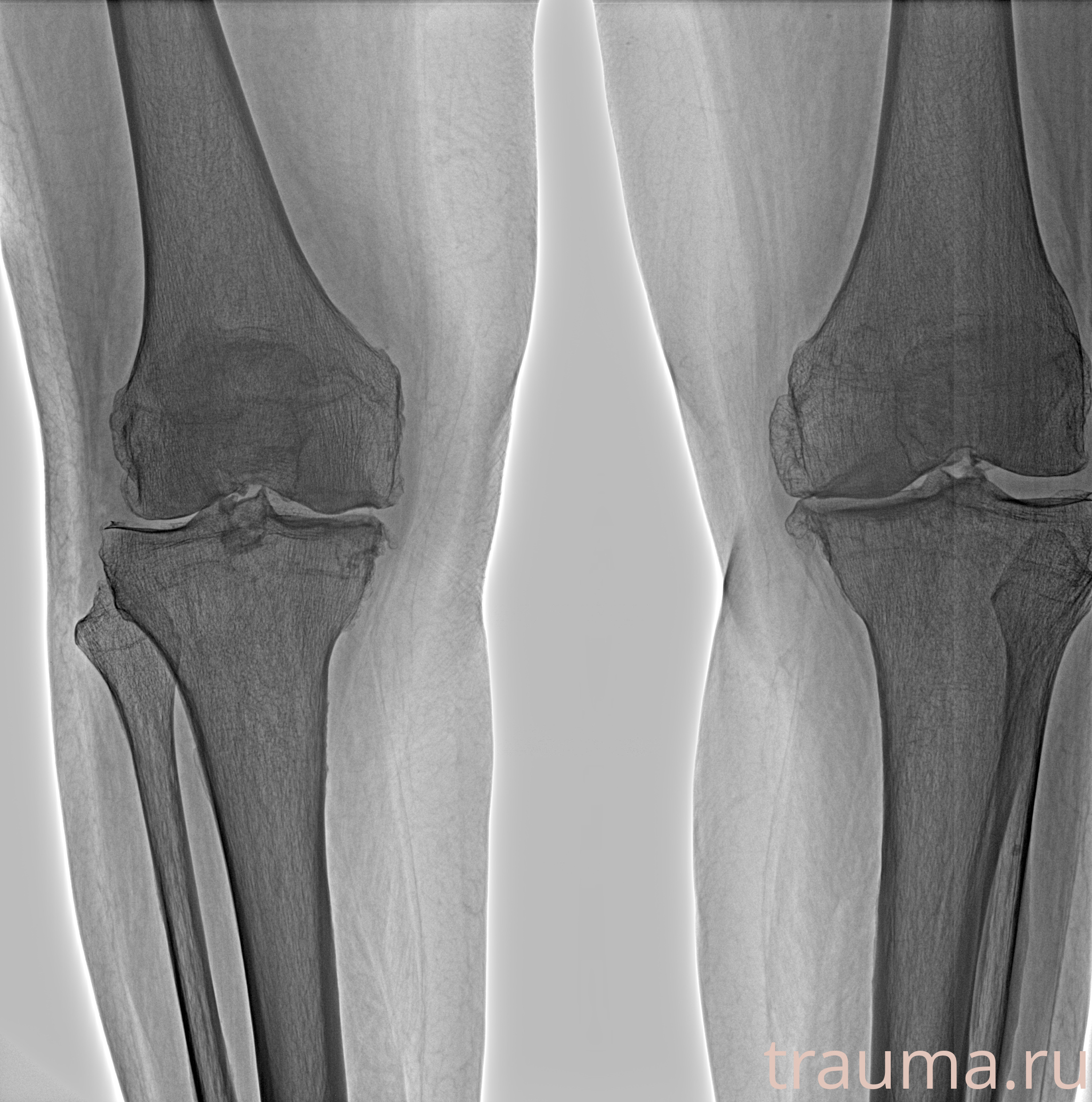 Рентген на дому: по вашему адресу приезжает врач-рентгенолог, травматолог-ортопед с мобильным рентгеновским аппаратом, проводит диагностику травмы или заболевания, делает необходимые рентгенограммы, дает рекомендации по дальнейшему лечению. Получить качественные снимки в домашних условиях возможно благодаря уникальной методике, разработанной МосРентген Центром для института  Склифосовского