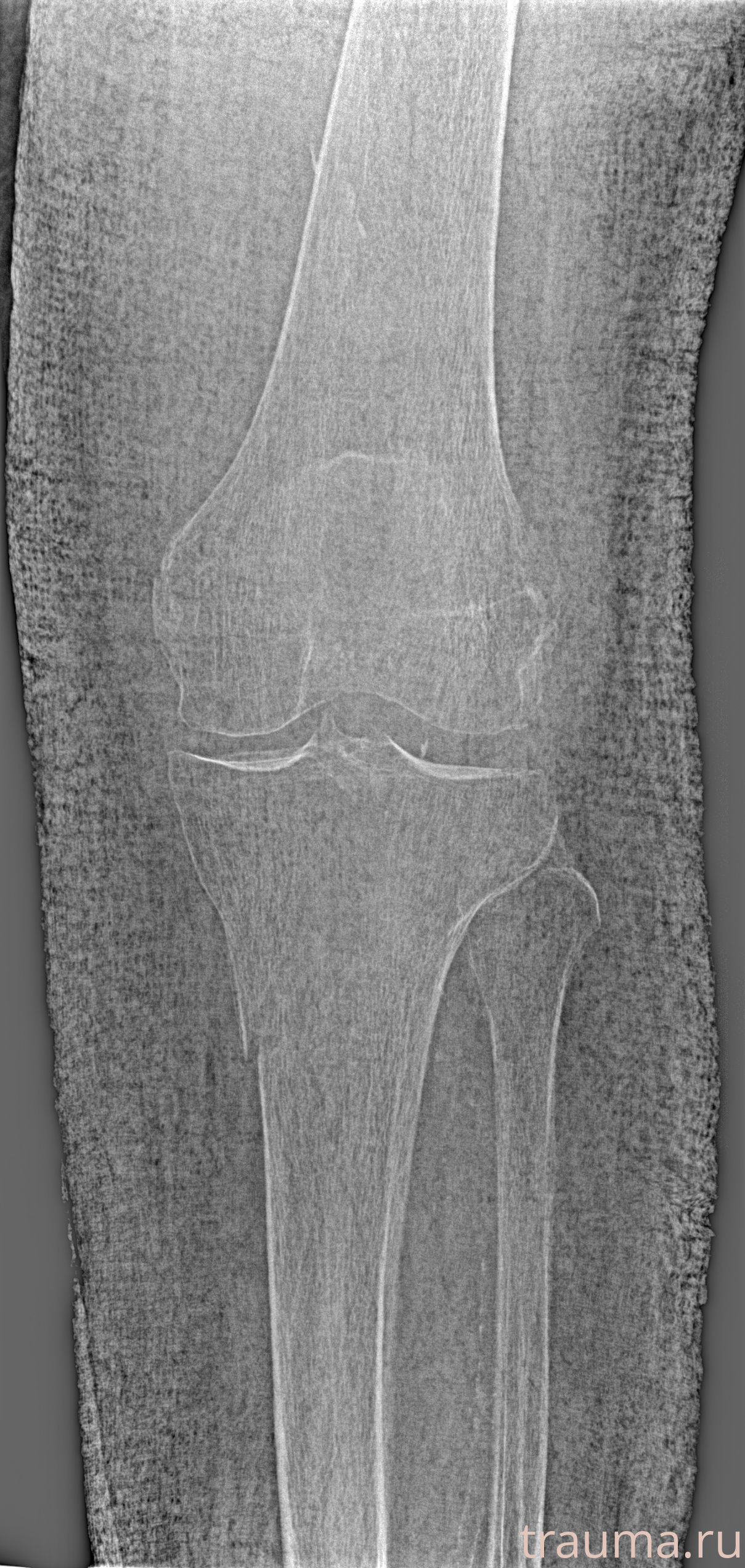 Рентген на дому: по вашему адресу приезжает врач-рентгенолог, травматолог-ортопед с мобильным рентгеновским аппаратом, проводит диагностику травмы или заболевания, делает необходимые рентгенограммы, дает рекомендации по дальнейшему лечению. Получить качественные снимки в домашних условиях возможно благодаря уникальной методике, разработанной МосРентген Центром для института  Склифосовского