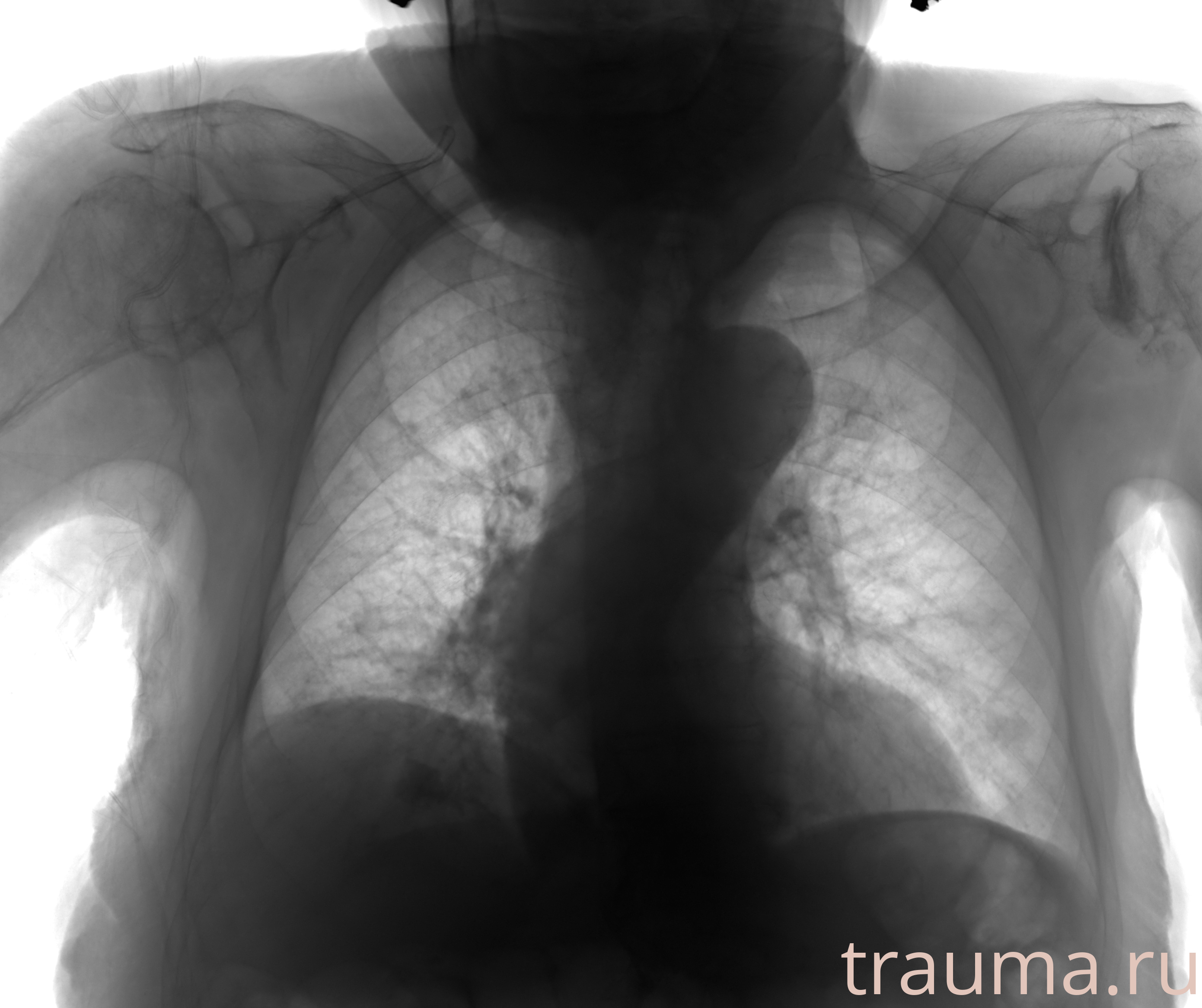 Рентген на дому: по вашему адресу приезжает врач-рентгенолог, травматолог-ортопед с мобильным рентгеновским аппаратом, проводит диагностику травмы или заболевания, делает необходимые рентгенограммы, дает рекомендации по дальнейшему лечению. Получить качественные снимки в домашних условиях возможно благодаря уникальной методике, разработанной МосРентген Центром для института  Склифосовского