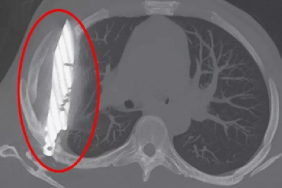 В Танзании мужчина восемь лет жил с ножом в груди В Танзании мужчина восемь лет жил с ножом в груди