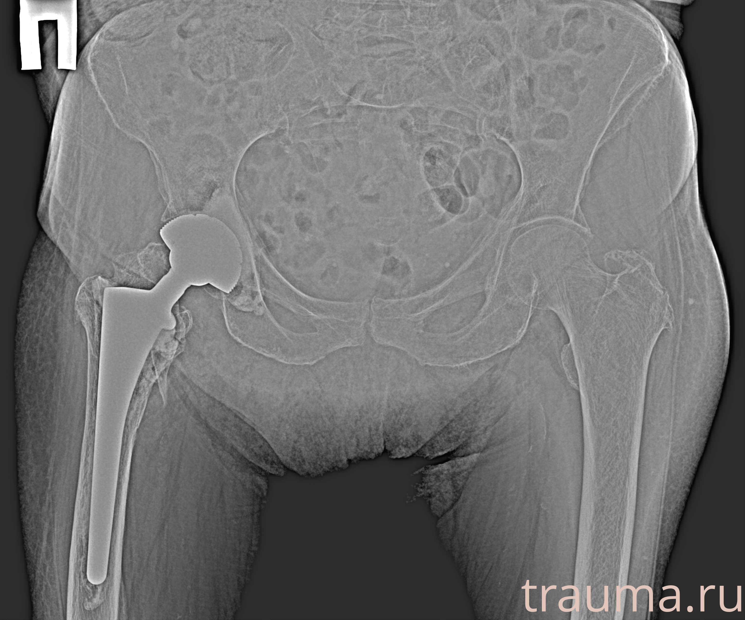 Рентген на дому: по вашему адресу приезжает врач-рентгенолог, травматолог-ортопед с мобильным рентгеновским аппаратом, проводит диагностику травмы или заболевания, делает необходимые рентгенограммы, дает рекомендации по дальнейшему лечению. Получить качественные снимки в домашних условиях возможно благодаря уникальной методике, разработанной МосРентген Центром для института  Склифосовского