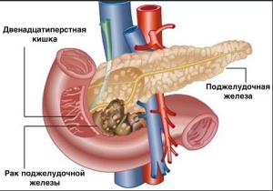 Рак поджелудочной железы Рак поджелудочной железы