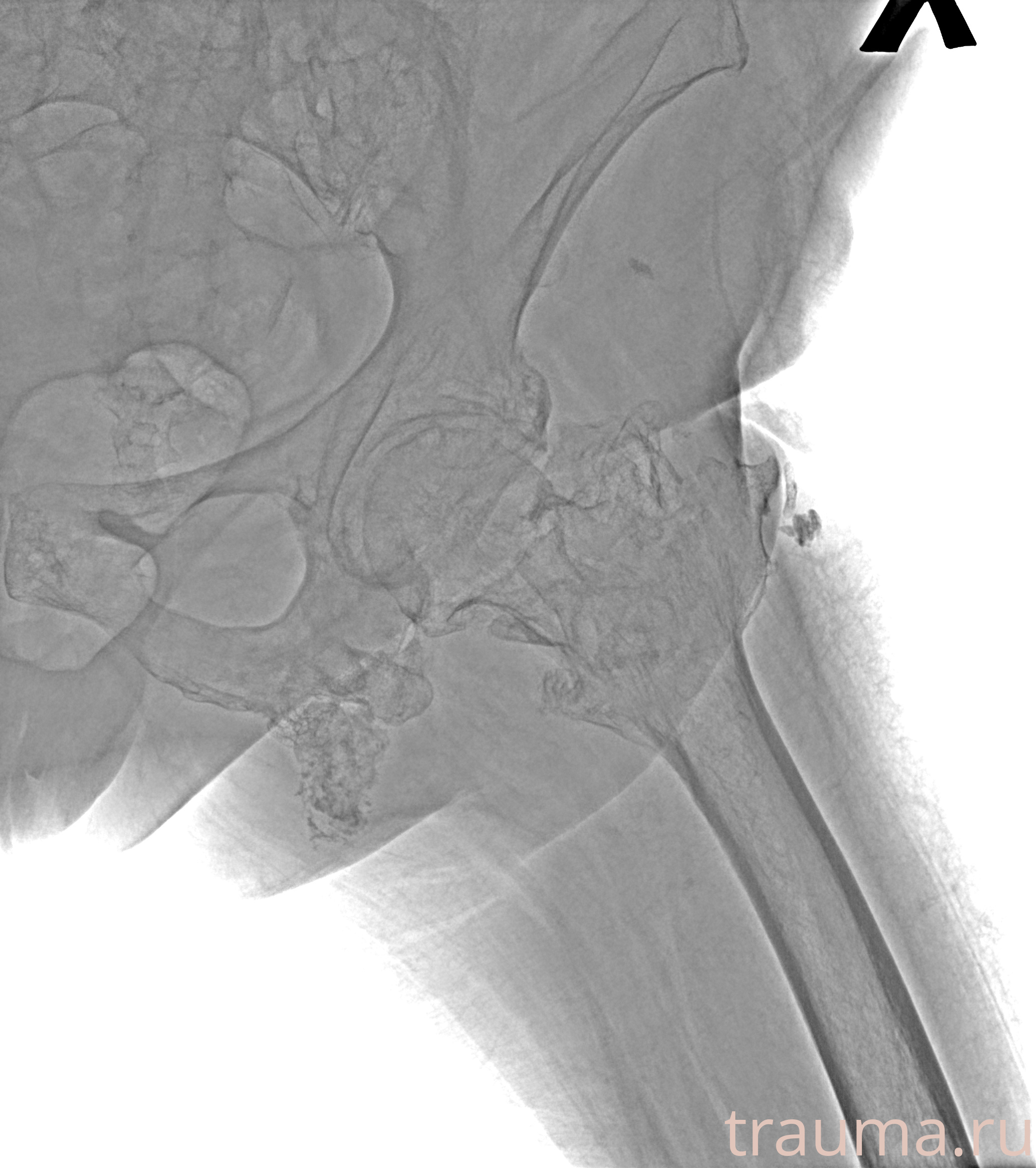Рентген на дому: по вашему адресу приезжает врач-рентгенолог, травматолог-ортопед с мобильным рентгеновским аппаратом, проводит диагностику травмы или заболевания, делает необходимые рентгенограммы, дает рекомендации по дальнейшему лечению. Получить качественные снимки в домашних условиях возможно благодаря уникальной методике, разработанной МосРентген Центром для института  Склифосовского