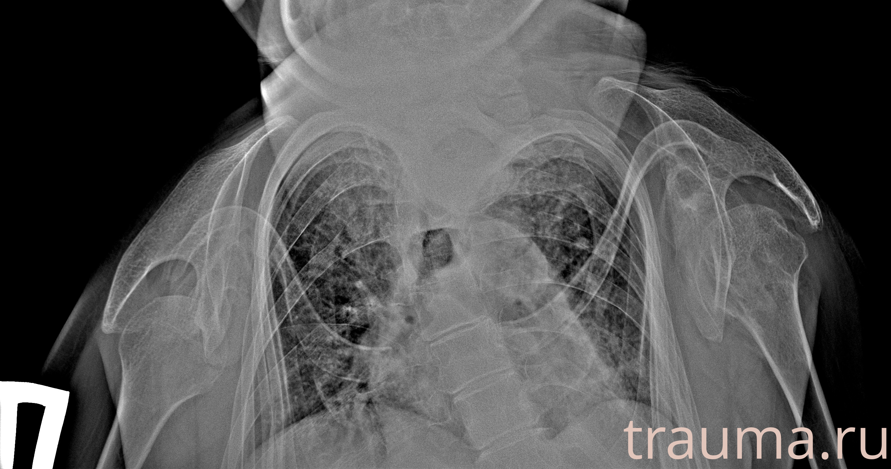 Рентген на дому: по вашему адресу приезжает врач-рентгенолог, травматолог-ортопед с мобильным рентгеновским аппаратом, проводит диагностику травмы или заболевания, делает необходимые рентгенограммы, дает рекомендации по дальнейшему лечению. Получить качественные снимки в домашних условиях возможно благодаря уникальной методике, разработанной МосРентген Центром для института  Склифосовского