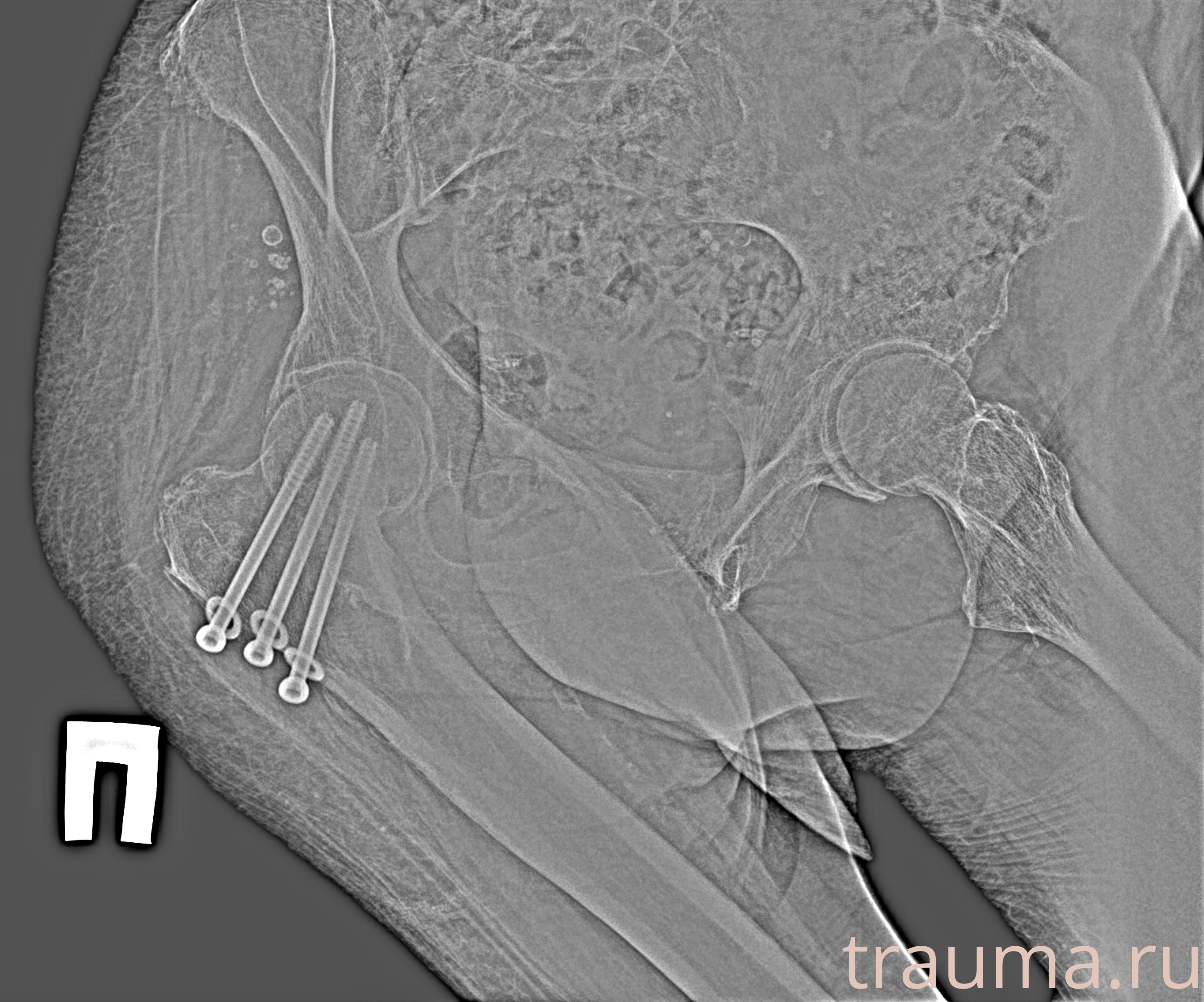 Рентген на дому: по вашему адресу приезжает врач-рентгенолог, травматолог-ортопед с мобильным рентгеновским аппаратом, проводит диагностику травмы или заболевания, делает необходимые рентгенограммы, дает рекомендации по дальнейшему лечению. Получить качественные снимки в домашних условиях возможно благодаря уникальной методике, разработанной МосРентген Центром для института  Склифосовского