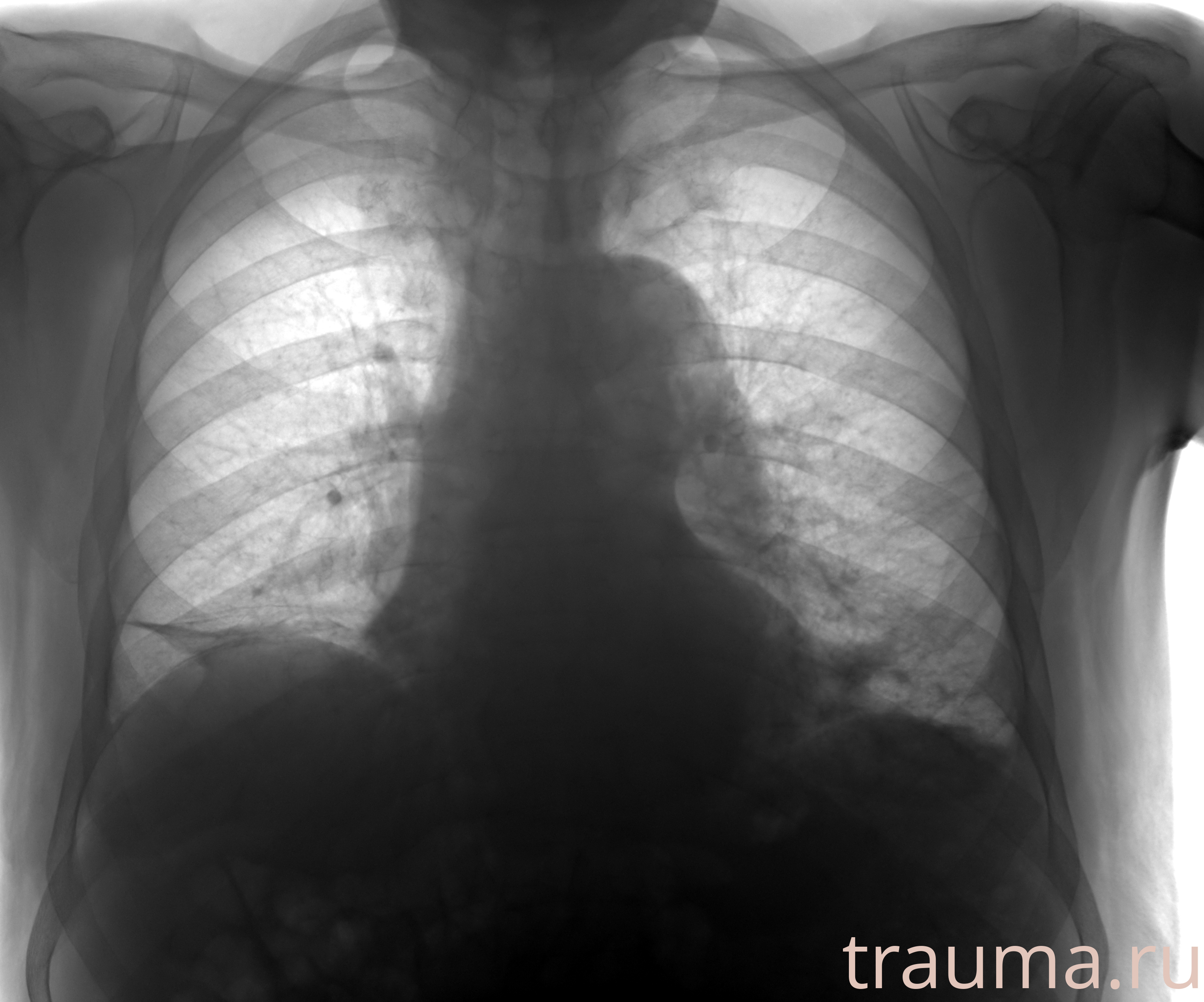 Рентген на дому: по вашему адресу приезжает врач-рентгенолог, травматолог-ортопед с мобильным рентгеновским аппаратом, проводит диагностику травмы или заболевания, делает необходимые рентгенограммы, дает рекомендации по дальнейшему лечению. Получить качественные снимки в домашних условиях возможно благодаря уникальной методике, разработанной МосРентген Центром для института  Склифосовского