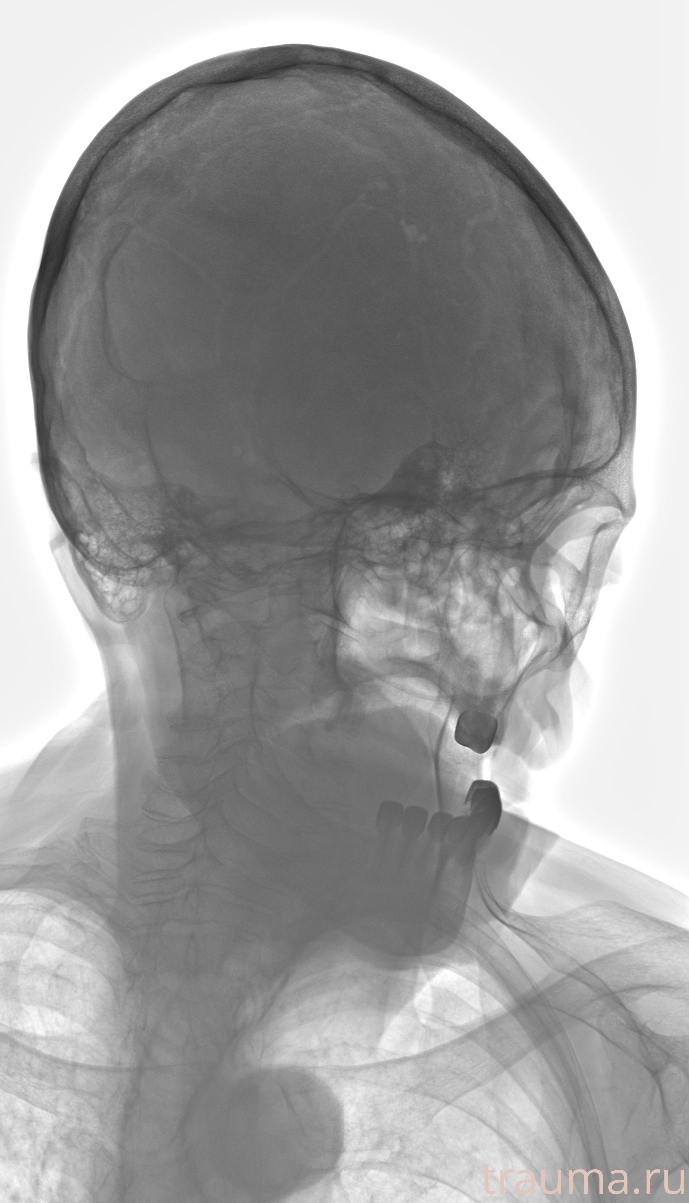 Рентген на дому: по вашему адресу приезжает врач-рентгенолог, травматолог-ортопед с мобильным рентгеновским аппаратом, проводит диагностику травмы или заболевания, делает необходимые рентгенограммы, дает рекомендации по дальнейшему лечению. Получить качественные снимки в домашних условиях возможно благодаря уникальной методике, разработанной МосРентген Центром для института  Склифосовского