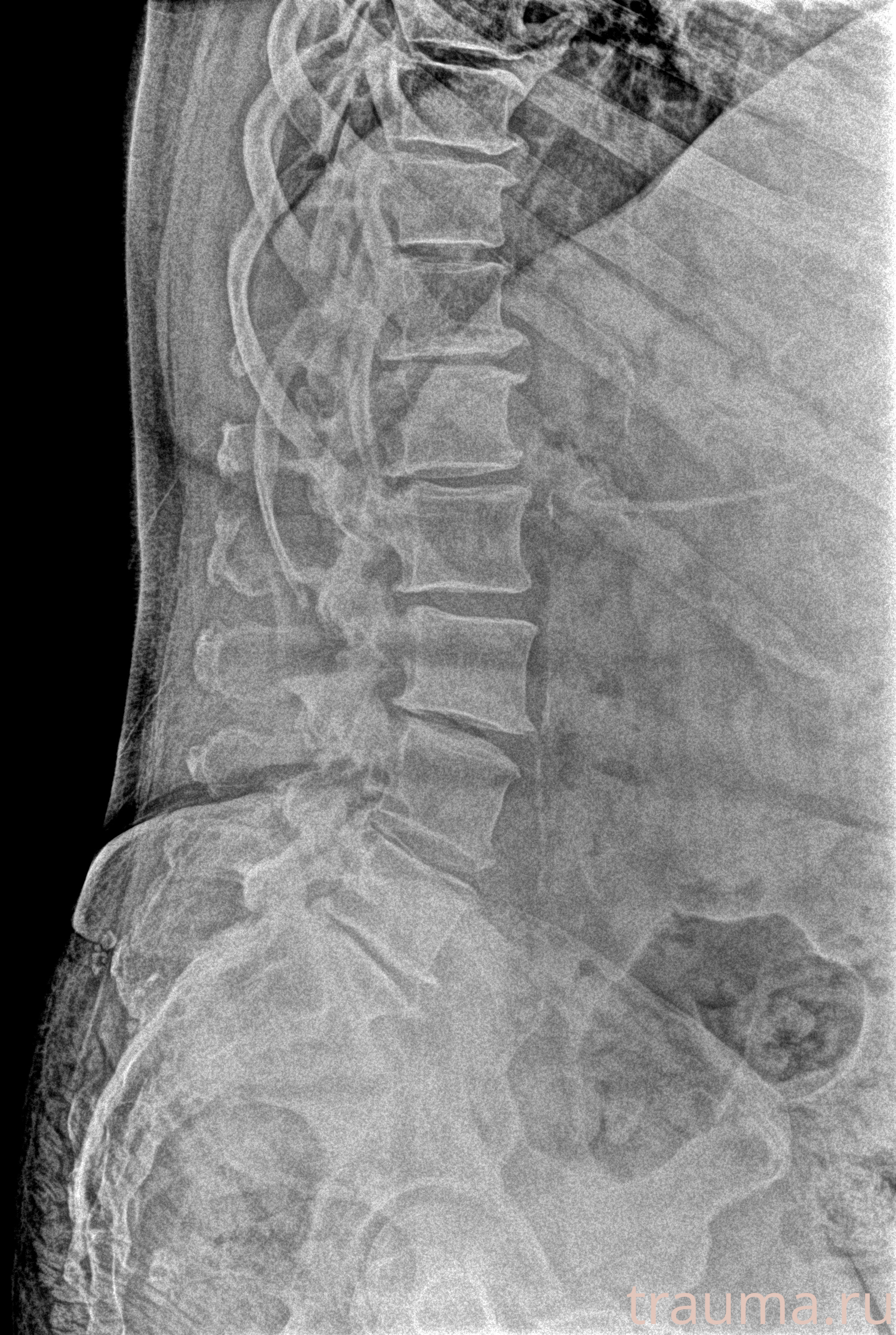 Рентген на дому: по вашему адресу приезжает врач-рентгенолог, травматолог-ортопед с мобильным рентгеновским аппаратом, проводит диагностику травмы или заболевания, делает необходимые рентгенограммы, дает рекомендации по дальнейшему лечению. Получить качественные снимки в домашних условиях возможно благодаря уникальной методике, разработанной МосРентген Центром для института  Склифосовского