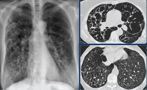Интерстициальные заболевания легких в клинической практике