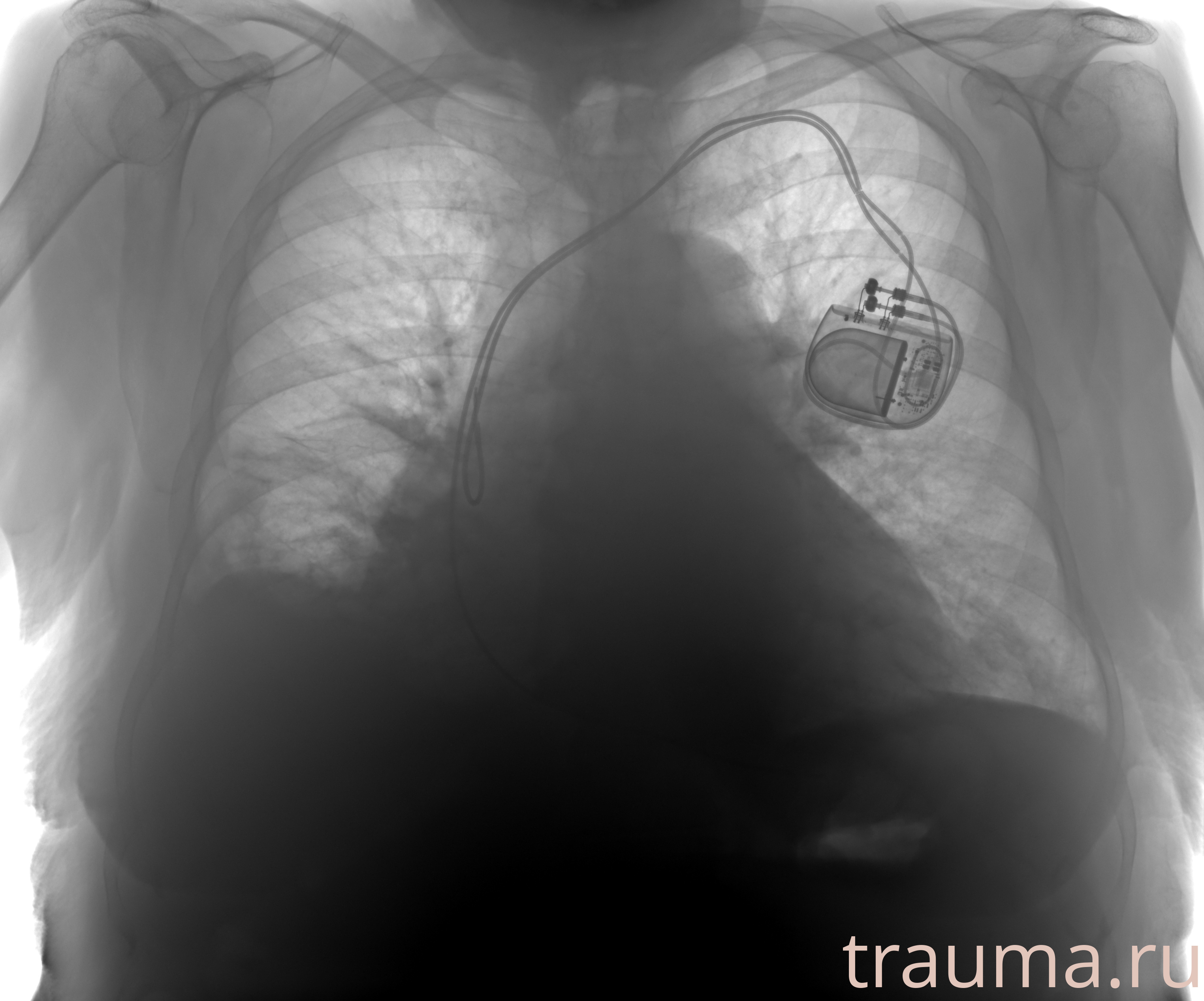 Рентген на дому: по вашему адресу приезжает врач-рентгенолог, травматолог-ортопед с мобильным рентгеновским аппаратом, проводит диагностику травмы или заболевания, делает необходимые рентгенограммы, дает рекомендации по дальнейшему лечению. Получить качественные снимки в домашних условиях возможно благодаря уникальной методике, разработанной МосРентген Центром для института  Склифосовского