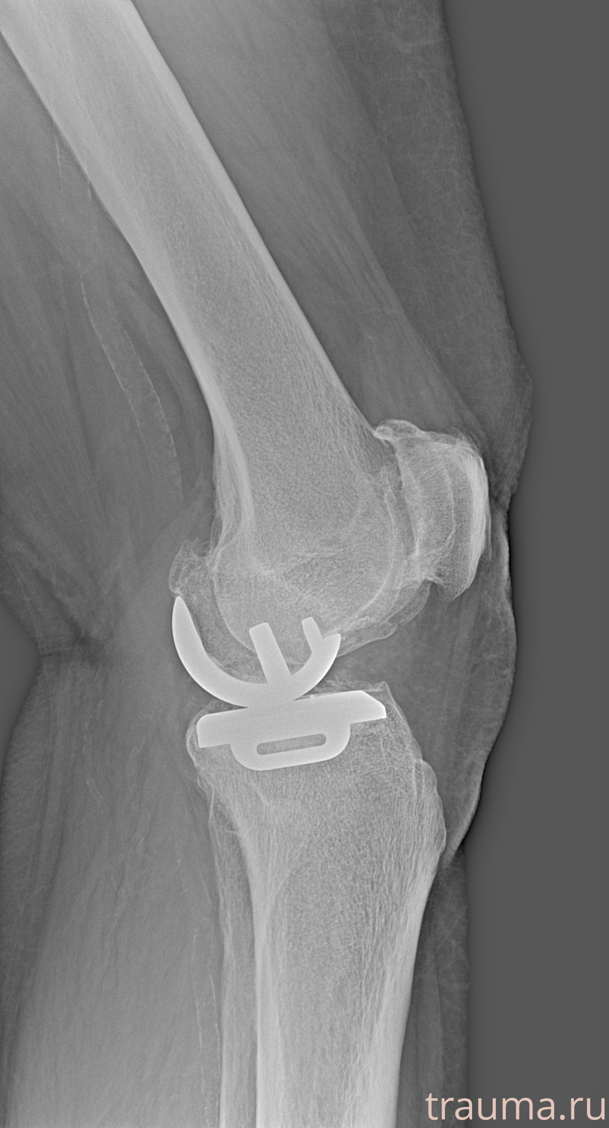 Рентген на дому: по вашему адресу приезжает врач-рентгенолог, травматолог-ортопед с мобильным рентгеновским аппаратом, проводит диагностику травмы или заболевания, делает необходимые рентгенограммы, дает рекомендации по дальнейшему лечению. Получить качественные снимки в домашних условиях возможно благодаря уникальной методике, разработанной МосРентген Центром для института  Склифосовского