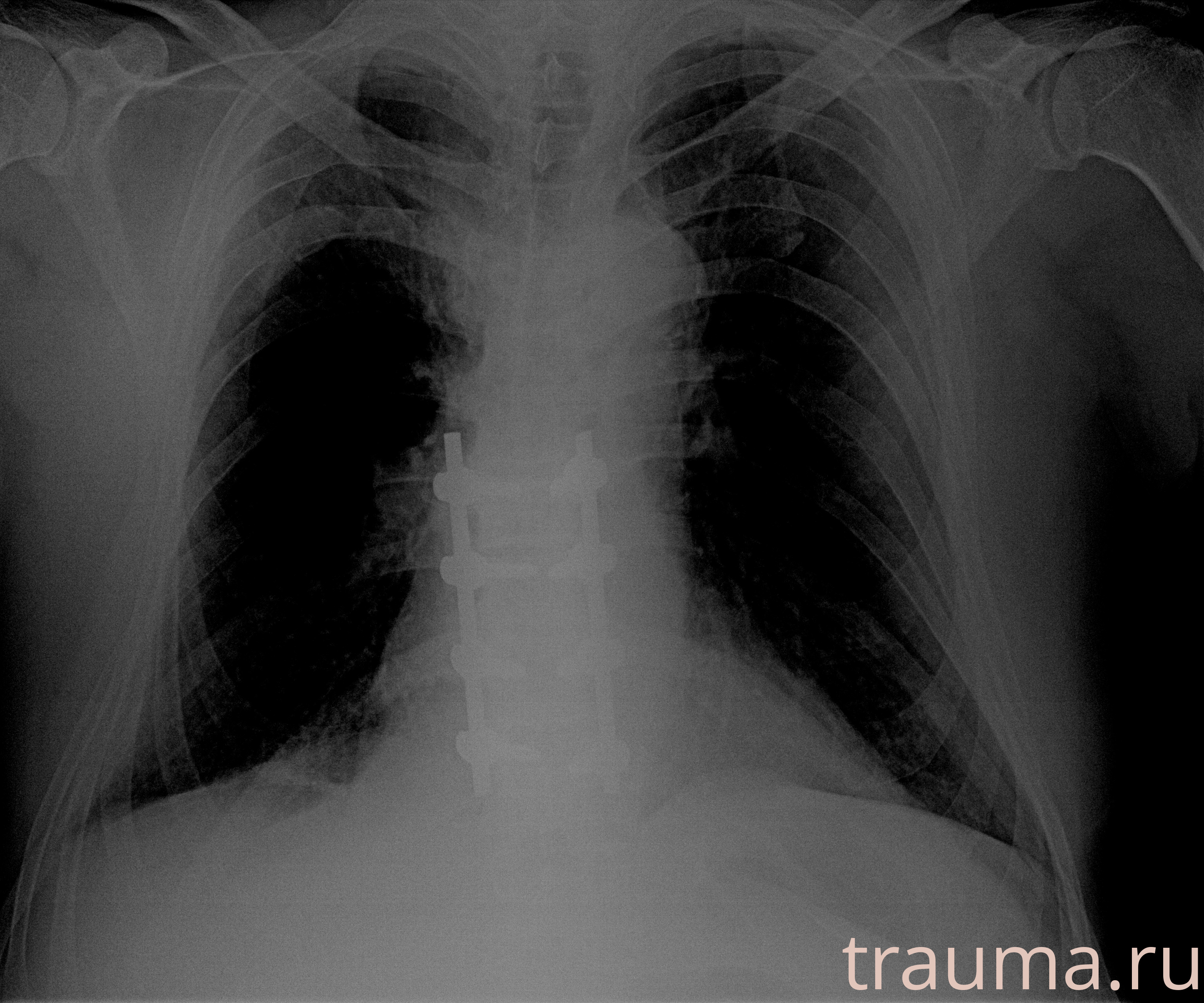 Рентген на дому: по вашему адресу приезжает врач-рентгенолог, травматолог-ортопед с мобильным рентгеновским аппаратом, проводит диагностику травмы или заболевания, делает необходимые рентгенограммы, дает рекомендации по дальнейшему лечению. Получить качественные снимки в домашних условиях возможно благодаря уникальной методике, разработанной МосРентген Центром для института  Склифосовского