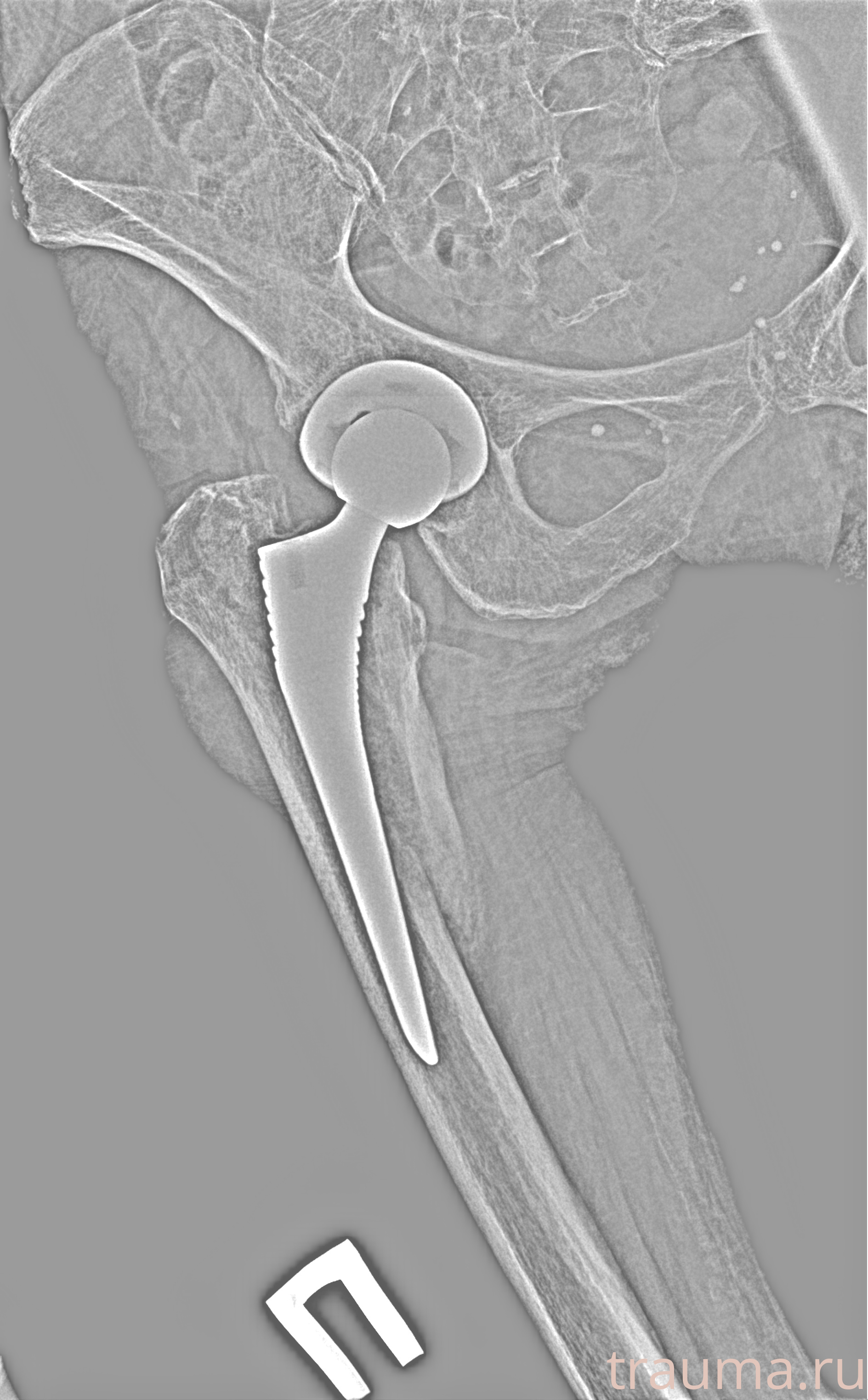 Рентген на дому: по вашему адресу приезжает врач-рентгенолог, травматолог-ортопед с мобильным рентгеновским аппаратом, проводит диагностику травмы или заболевания, делает необходимые рентгенограммы, дает рекомендации по дальнейшему лечению. Получить качественные снимки в домашних условиях возможно благодаря уникальной методике, разработанной МосРентген Центром для института  Склифосовского