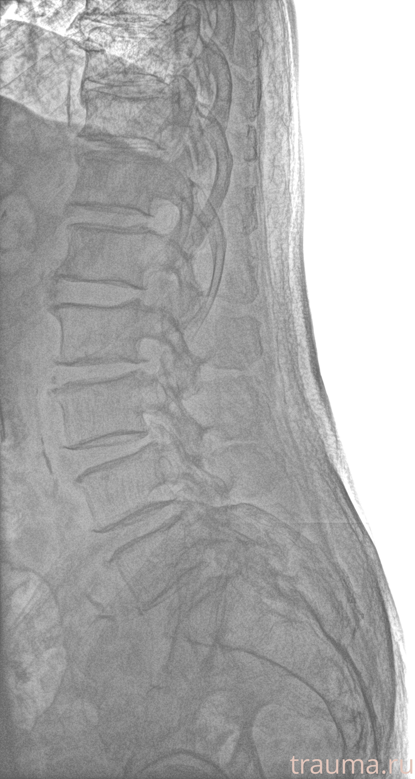 Рентген на дому: по вашему адресу приезжает врач-рентгенолог, травматолог-ортопед с мобильным рентгеновским аппаратом, проводит диагностику травмы или заболевания, делает необходимые рентгенограммы, дает рекомендации по дальнейшему лечению. Получить качественные снимки в домашних условиях возможно благодаря уникальной методике, разработанной МосРентген Центром для института  Склифосовского
