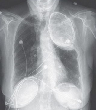 Случайная находка – олеоторакс