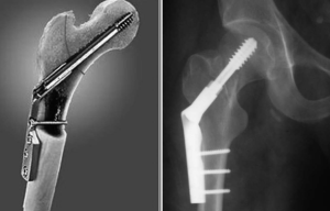 Полисегментарный дистракционный остеосинтез в комбинации с телескопическим трансфизарным стержнем при болезни Олье