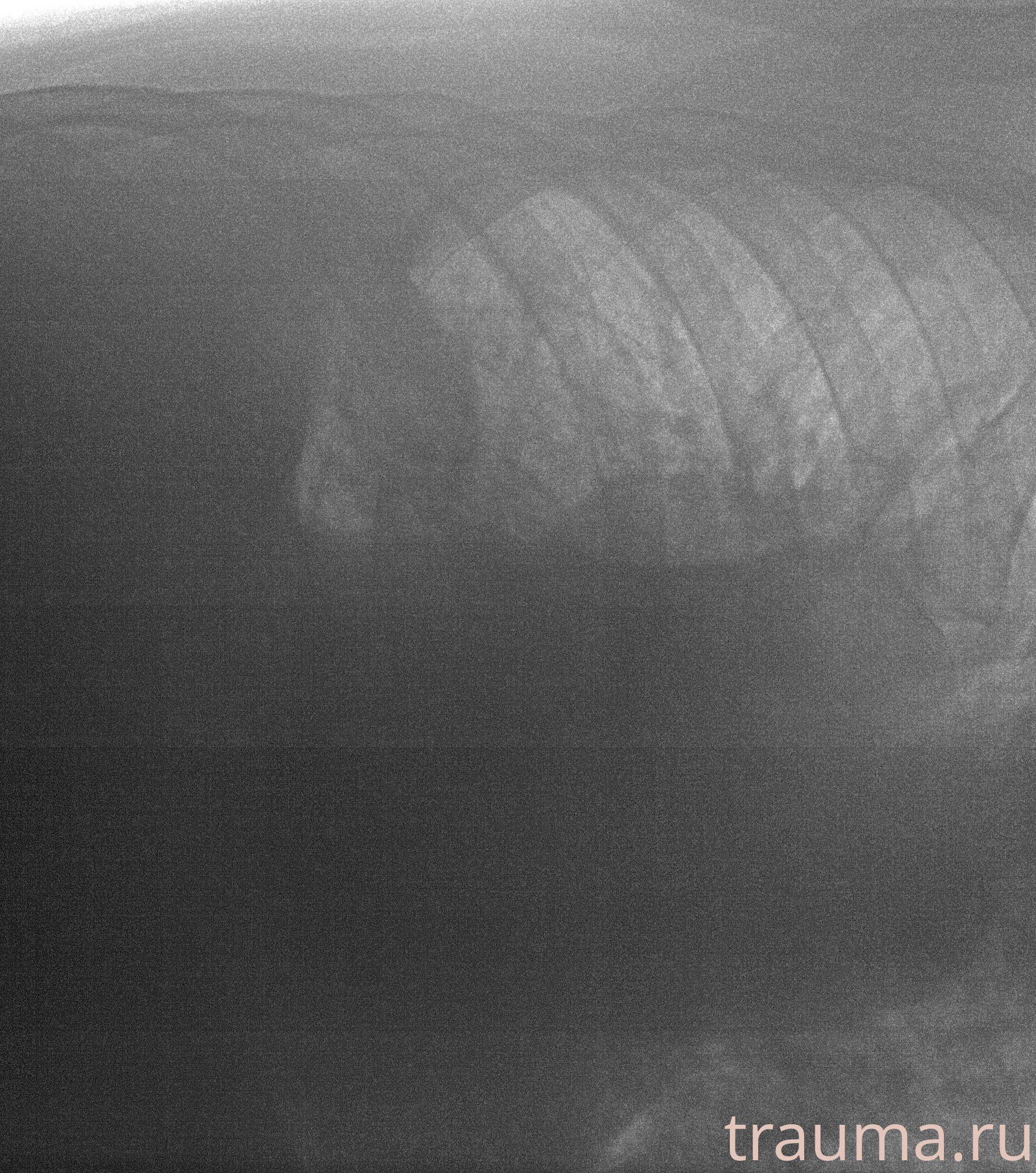 Рентген на дому: по вашему адресу приезжает врач-рентгенолог, травматолог-ортопед с мобильным рентгеновским аппаратом, проводит диагностику травмы или заболевания, делает необходимые рентгенограммы, дает рекомендации по дальнейшему лечению. Получить качественные снимки в домашних условиях возможно благодаря уникальной методике, разработанной МосРентген Центром для института  Склифосовского