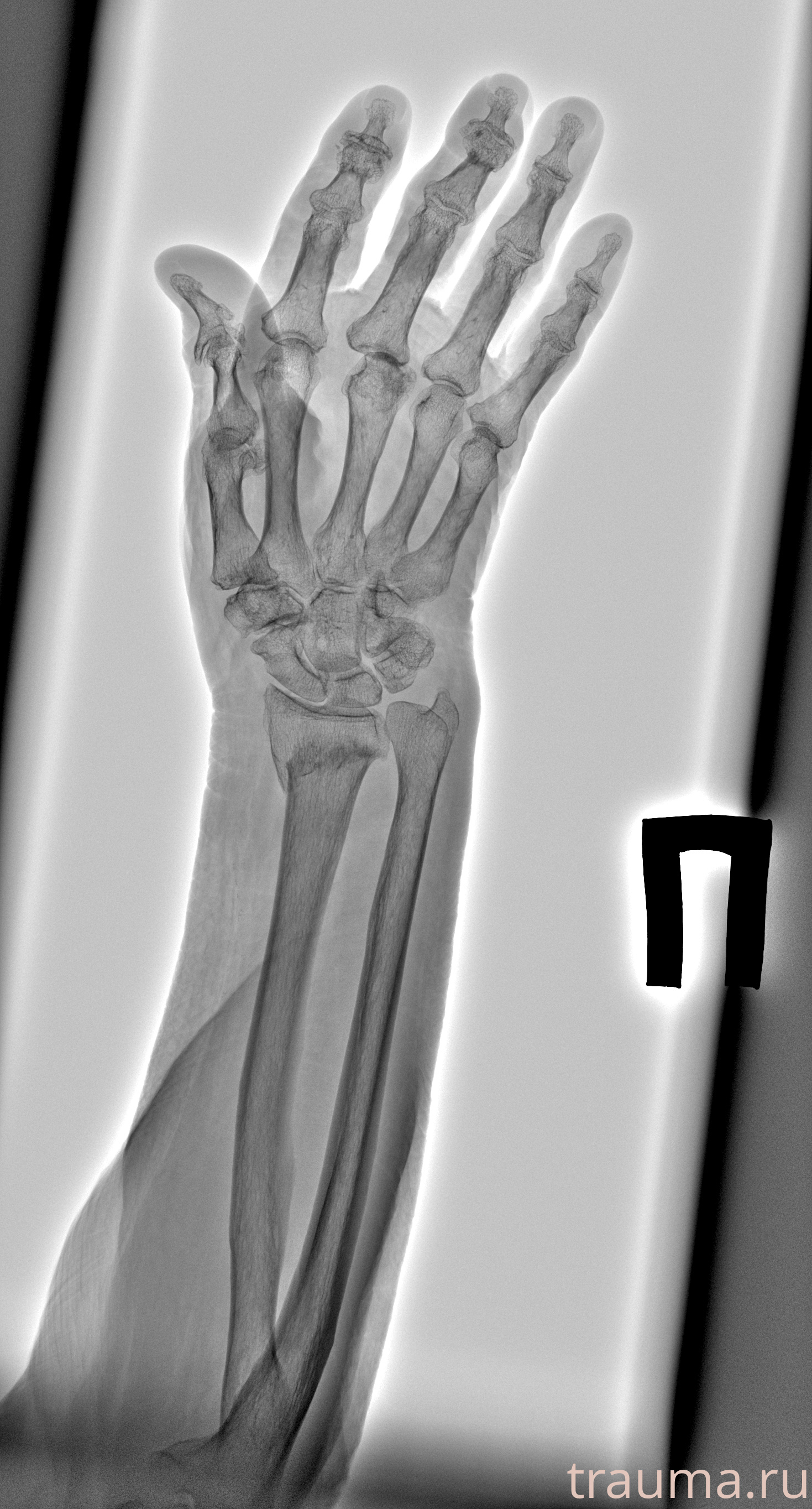 Рентген на дому: по вашему адресу приезжает врач-рентгенолог, травматолог-ортопед с мобильным рентгеновским аппаратом, проводит диагностику травмы или заболевания, делает необходимые рентгенограммы, дает рекомендации по дальнейшему лечению. Получить качественные снимки в домашних условиях возможно благодаря уникальной методике, разработанной МосРентген Центром для института  Склифосовского