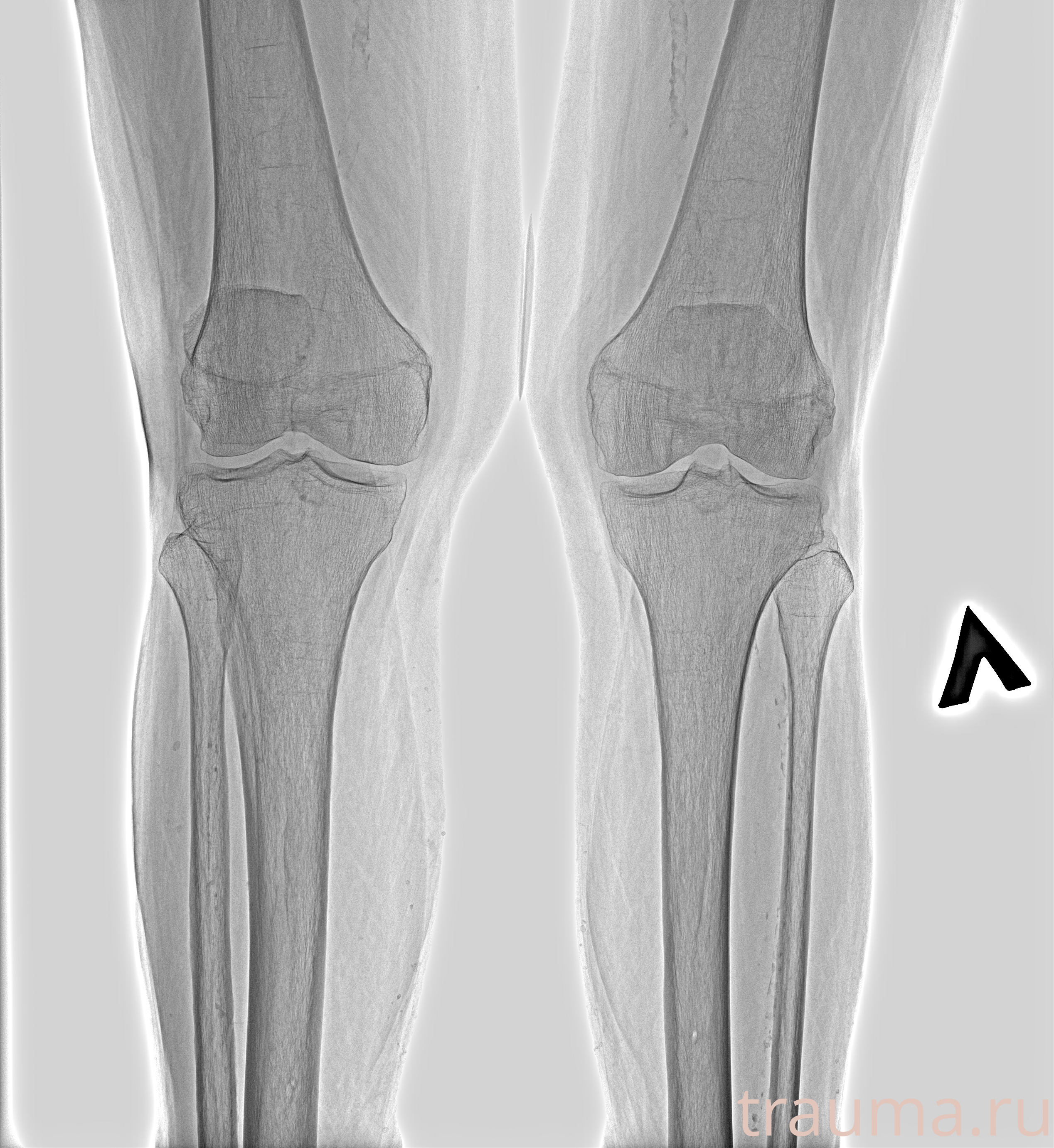 Рентген на дому: по вашему адресу приезжает врач-рентгенолог, травматолог-ортопед с мобильным рентгеновским аппаратом, проводит диагностику травмы или заболевания, делает необходимые рентгенограммы, дает рекомендации по дальнейшему лечению. Получить качественные снимки в домашних условиях возможно благодаря уникальной методике, разработанной МосРентген Центром для института  Склифосовского