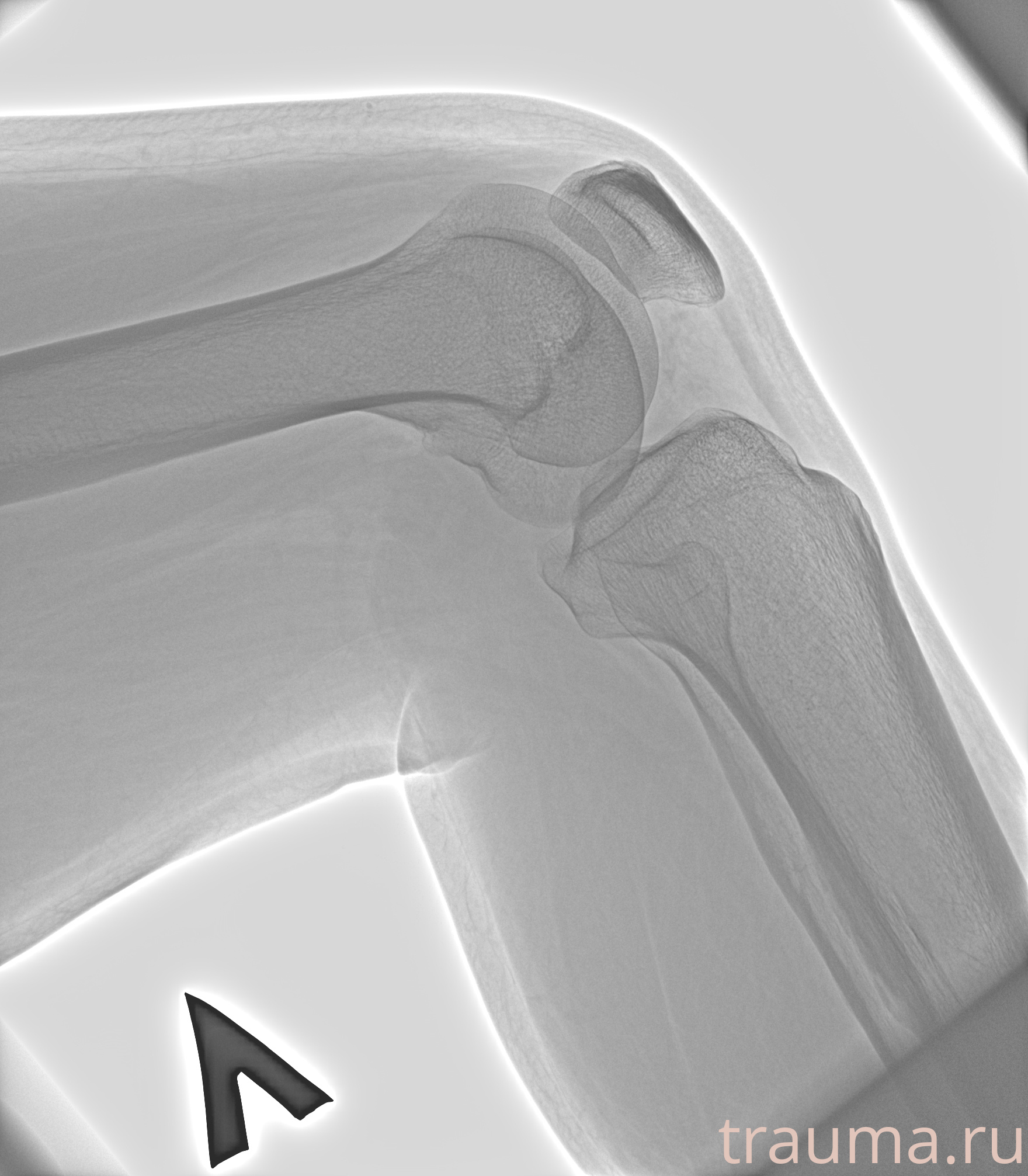 Рентген на дому: по вашему адресу приезжает врач-рентгенолог, травматолог-ортопед с мобильным рентгеновским аппаратом, проводит диагностику травмы или заболевания, делает необходимые рентгенограммы, дает рекомендации по дальнейшему лечению. Получить качественные снимки в домашних условиях возможно благодаря уникальной методике, разработанной МосРентген Центром для института  Склифосовского