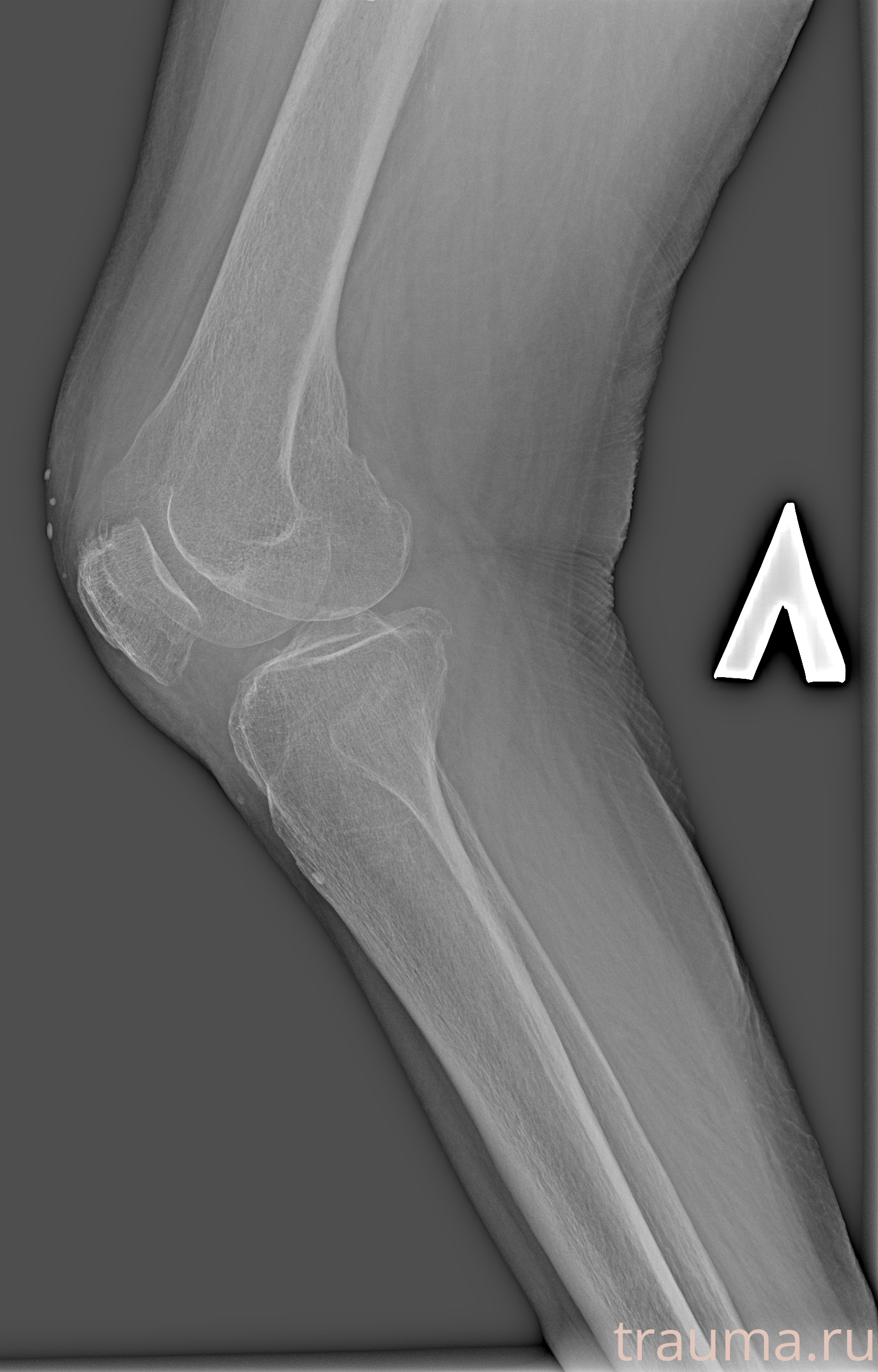Рентген на дому: по вашему адресу приезжает врач-рентгенолог, травматолог-ортопед с мобильным рентгеновским аппаратом, проводит диагностику травмы или заболевания, делает необходимые рентгенограммы, дает рекомендации по дальнейшему лечению. Получить качественные снимки в домашних условиях возможно благодаря уникальной методике, разработанной МосРентген Центром для института  Склифосовского