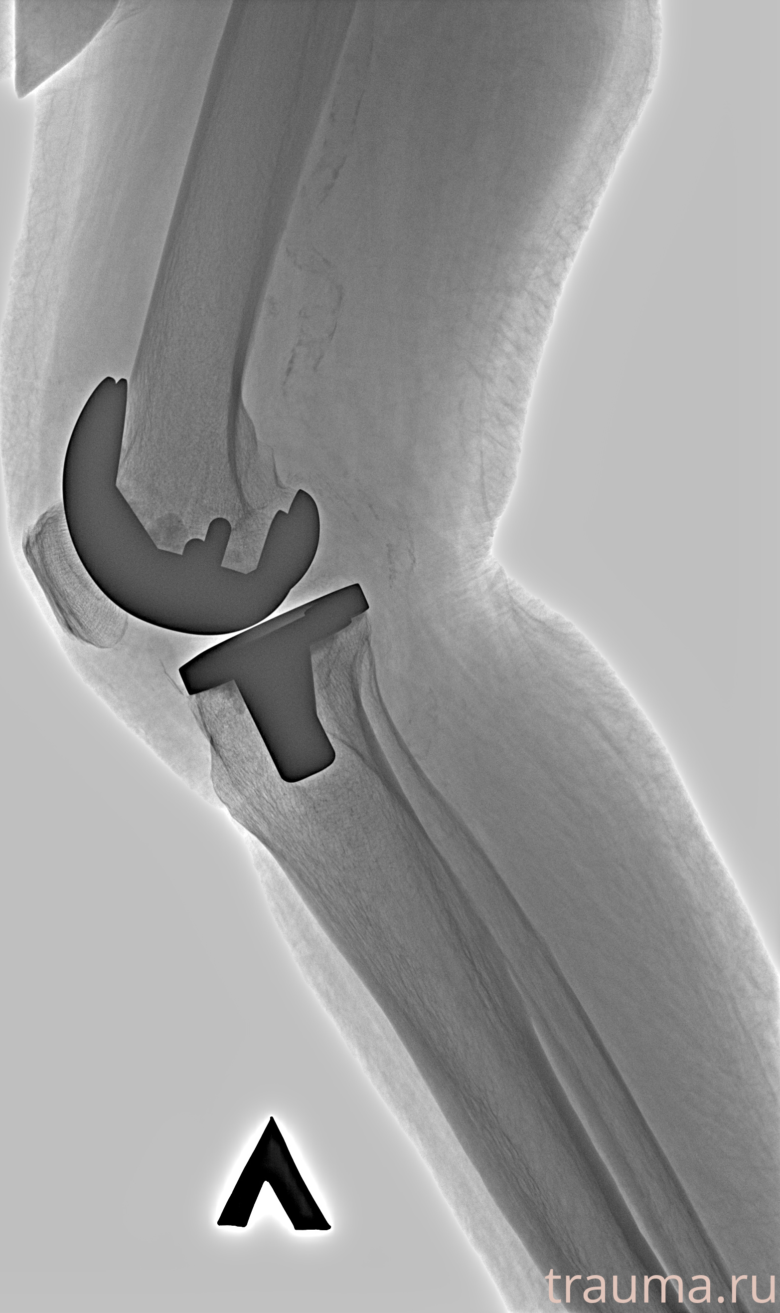 Рентген на дому: по вашему адресу приезжает врач-рентгенолог, травматолог-ортопед с мобильным рентгеновским аппаратом, проводит диагностику травмы или заболевания, делает необходимые рентгенограммы, дает рекомендации по дальнейшему лечению. Получить качественные снимки в домашних условиях возможно благодаря уникальной методике, разработанной МосРентген Центром для института  Склифосовского
