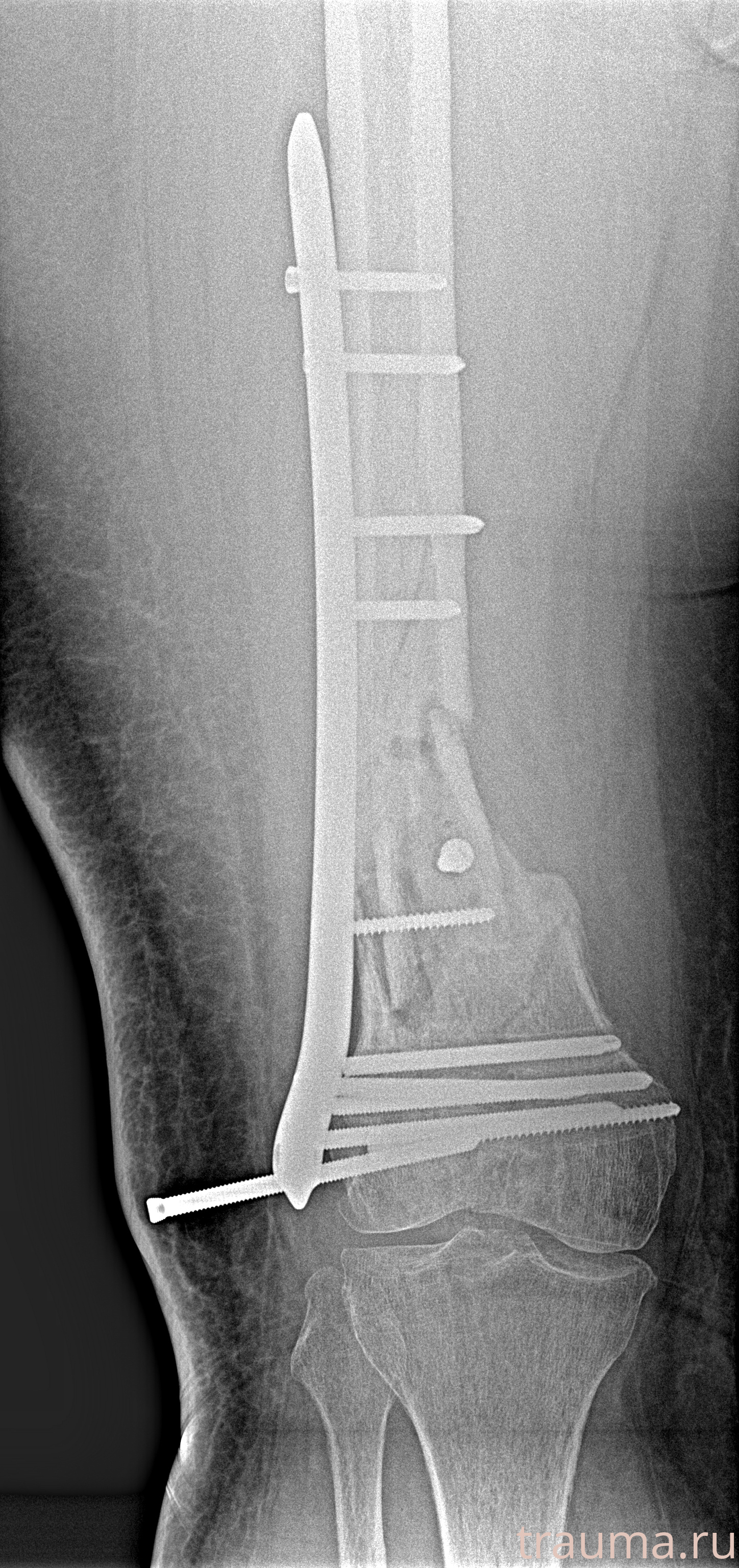 Рентген на дому: по вашему адресу приезжает врач-рентгенолог, травматолог-ортопед с мобильным рентгеновским аппаратом, проводит диагностику травмы или заболевания, делает необходимые рентгенограммы, дает рекомендации по дальнейшему лечению. Получить качественные снимки в домашних условиях возможно благодаря уникальной методике, разработанной МосРентген Центром для института  Склифосовского