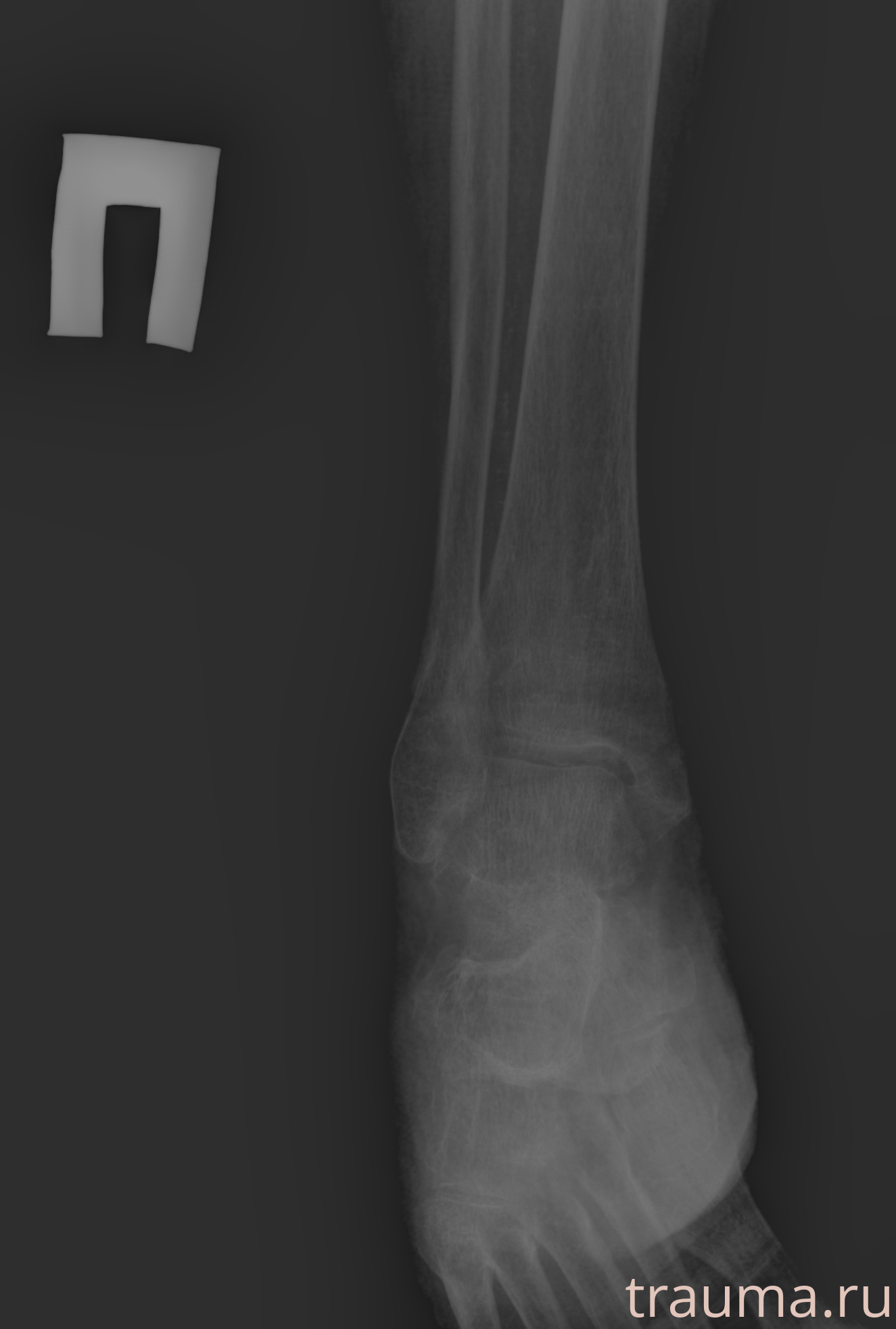 Рентген на дому: по вашему адресу приезжает врач-рентгенолог, травматолог-ортопед с мобильным рентгеновским аппаратом, проводит диагностику травмы или заболевания, делает необходимые рентгенограммы, дает рекомендации по дальнейшему лечению. Получить качественные снимки в домашних условиях возможно благодаря уникальной методике, разработанной МосРентген Центром для института  Склифосовского