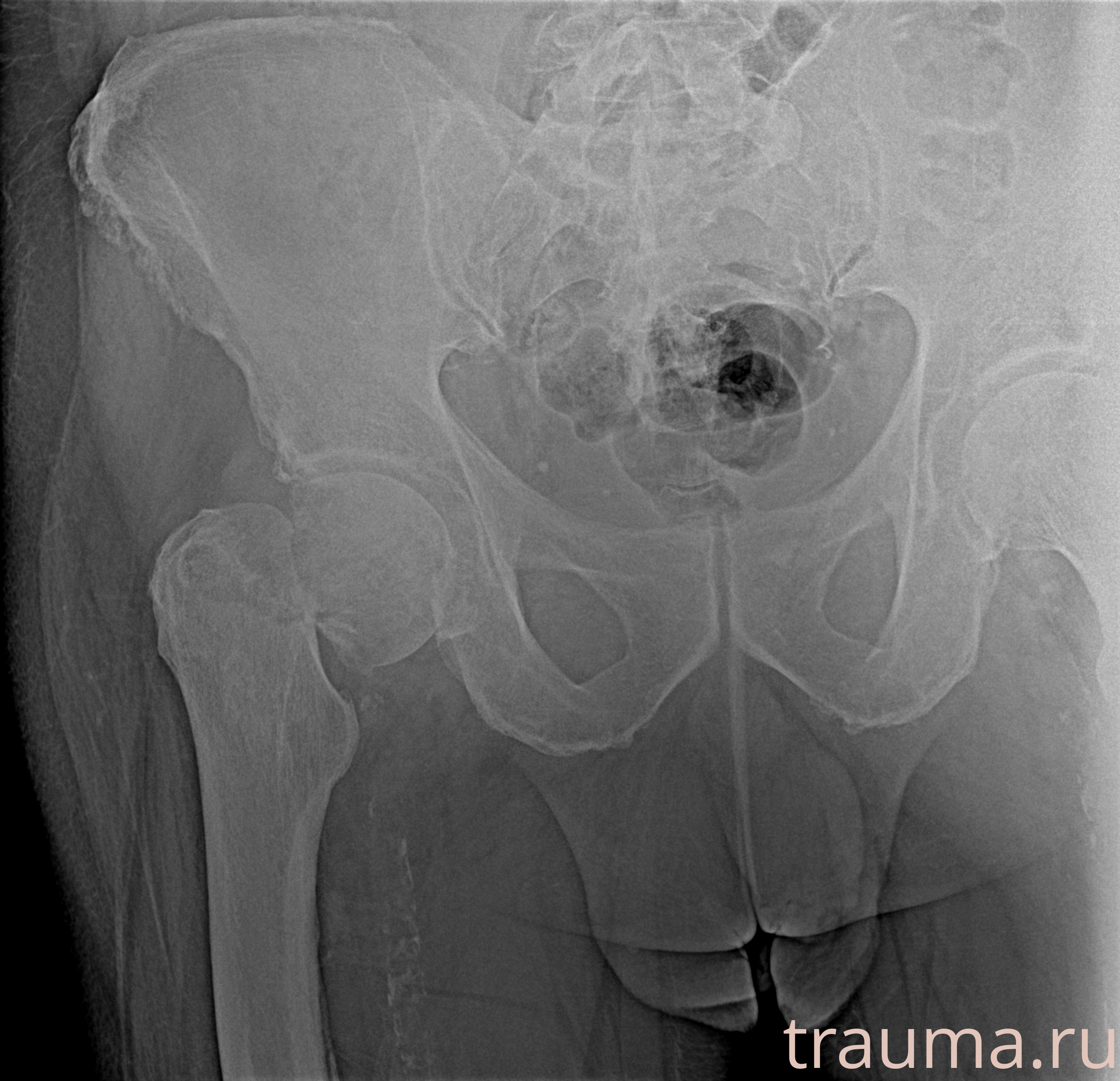 Рентген на дому: по вашему адресу приезжает врач-рентгенолог, травматолог-ортопед с мобильным рентгеновским аппаратом, проводит диагностику травмы или заболевания, делает необходимые рентгенограммы, дает рекомендации по дальнейшему лечению. Получить качественные снимки в домашних условиях возможно благодаря уникальной методике, разработанной МосРентген Центром для института  Склифосовского