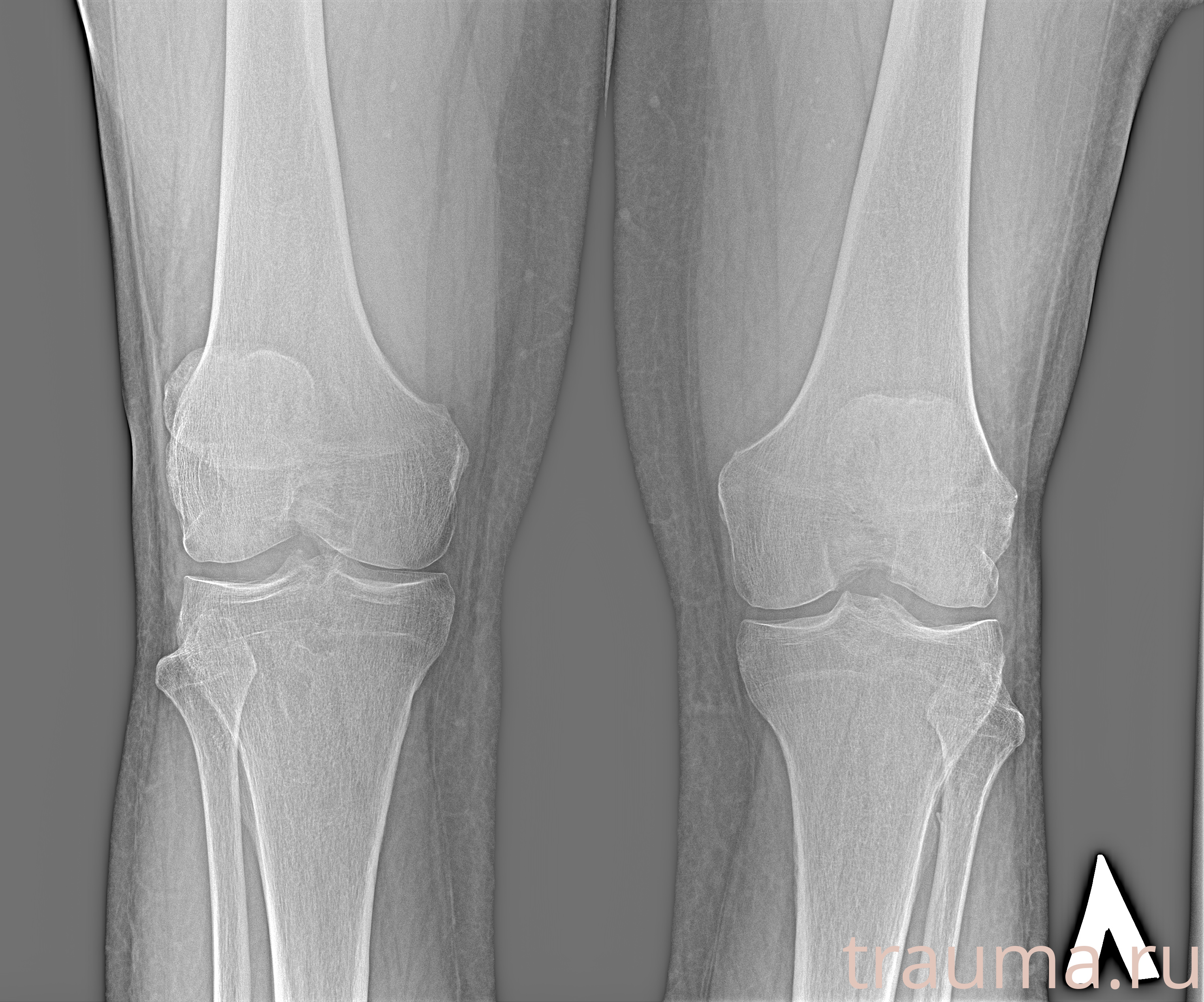 Рентген на дому: по вашему адресу приезжает врач-рентгенолог, травматолог-ортопед с мобильным рентгеновским аппаратом, проводит диагностику травмы или заболевания, делает необходимые рентгенограммы, дает рекомендации по дальнейшему лечению. Получить качественные снимки в домашних условиях возможно благодаря уникальной методике, разработанной МосРентген Центром для института  Склифосовского