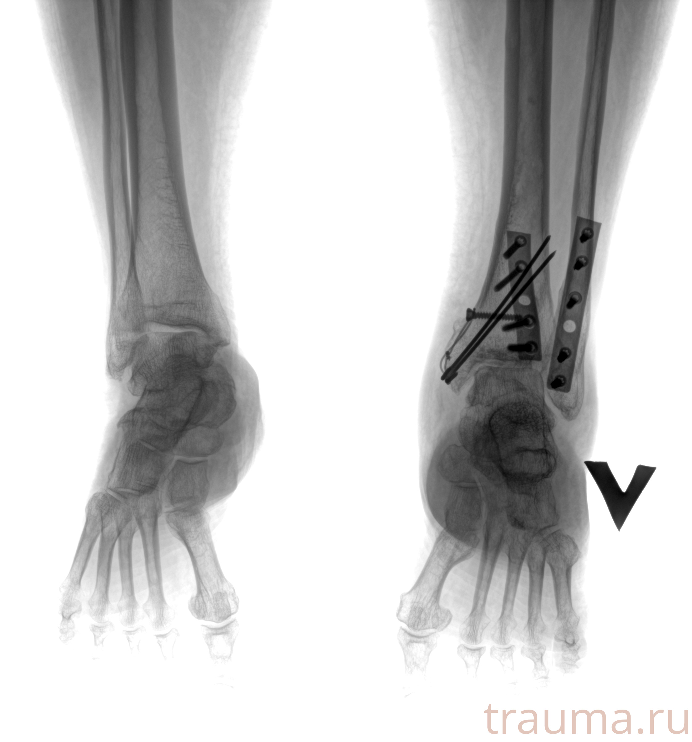 Рентген на дому: по вашему адресу приезжает врач-рентгенолог, травматолог-ортопед с мобильным рентгеновским аппаратом, проводит диагностику травмы или заболевания, делает необходимые рентгенограммы, дает рекомендации по дальнейшему лечению. Получить качественные снимки в домашних условиях возможно благодаря уникальной методике, разработанной МосРентген Центром для института  Склифосовского