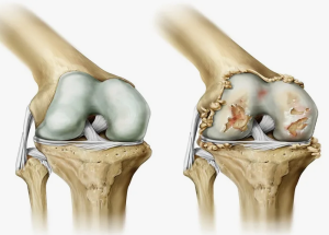 Остеоартроз коленного сустава