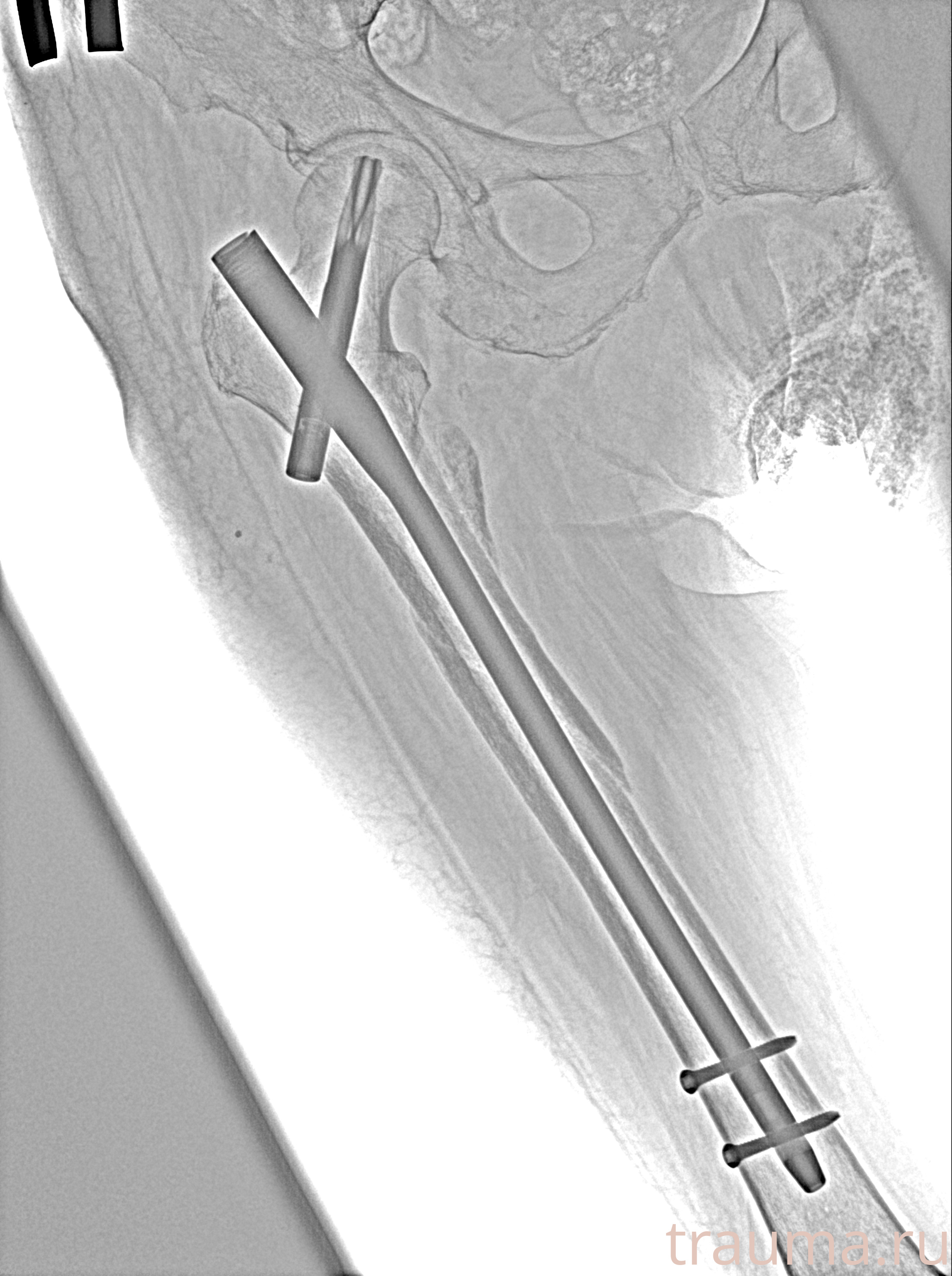 Рентген на дому: по вашему адресу приезжает врач-рентгенолог, травматолог-ортопед с мобильным рентгеновским аппаратом, проводит диагностику травмы или заболевания, делает необходимые рентгенограммы, дает рекомендации по дальнейшему лечению. Получить качественные снимки в домашних условиях возможно благодаря уникальной методике, разработанной МосРентген Центром для института  Склифосовского