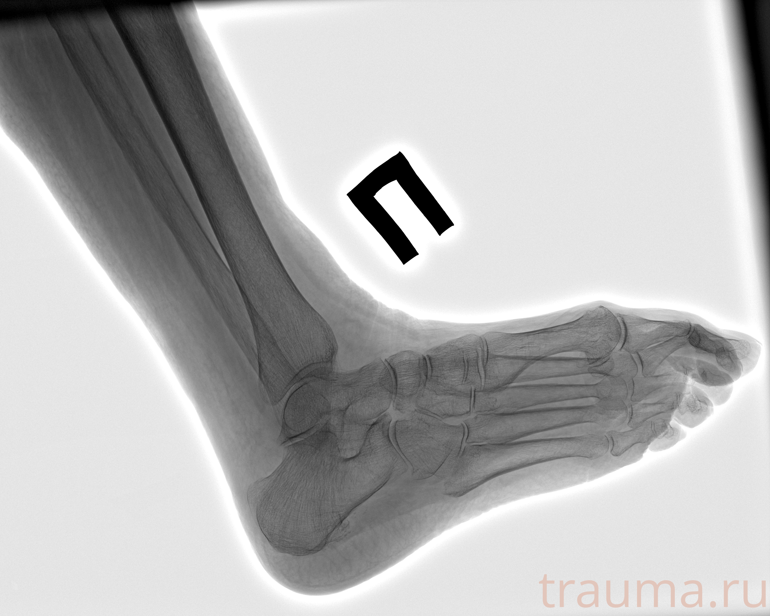 Рентген на дому: по вашему адресу приезжает врач-рентгенолог, травматолог-ортопед с мобильным рентгеновским аппаратом, проводит диагностику травмы или заболевания, делает необходимые рентгенограммы, дает рекомендации по дальнейшему лечению. Получить качественные снимки в домашних условиях возможно благодаря уникальной методике, разработанной МосРентген Центром для института  Склифосовского