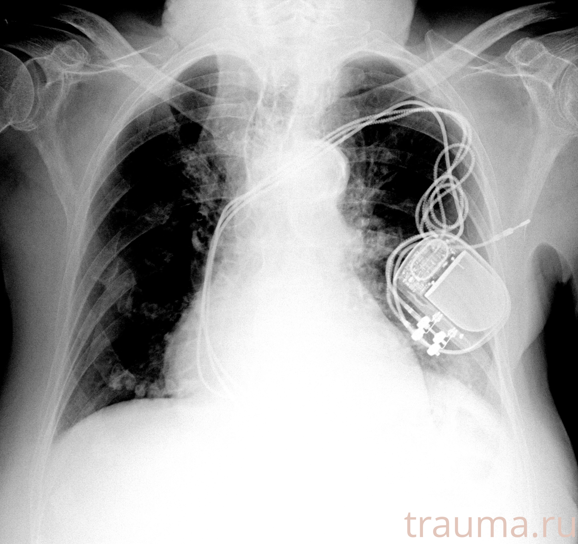 Рентген на дому: по вашему адресу приезжает врач-рентгенолог, травматолог-ортопед с мобильным рентгеновским аппаратом, проводит диагностику травмы или заболевания, делает необходимые рентгенограммы, дает рекомендации по дальнейшему лечению. Получить качественные снимки в домашних условиях возможно благодаря уникальной методике, разработанной МосРентген Центром для института  Склифосовского