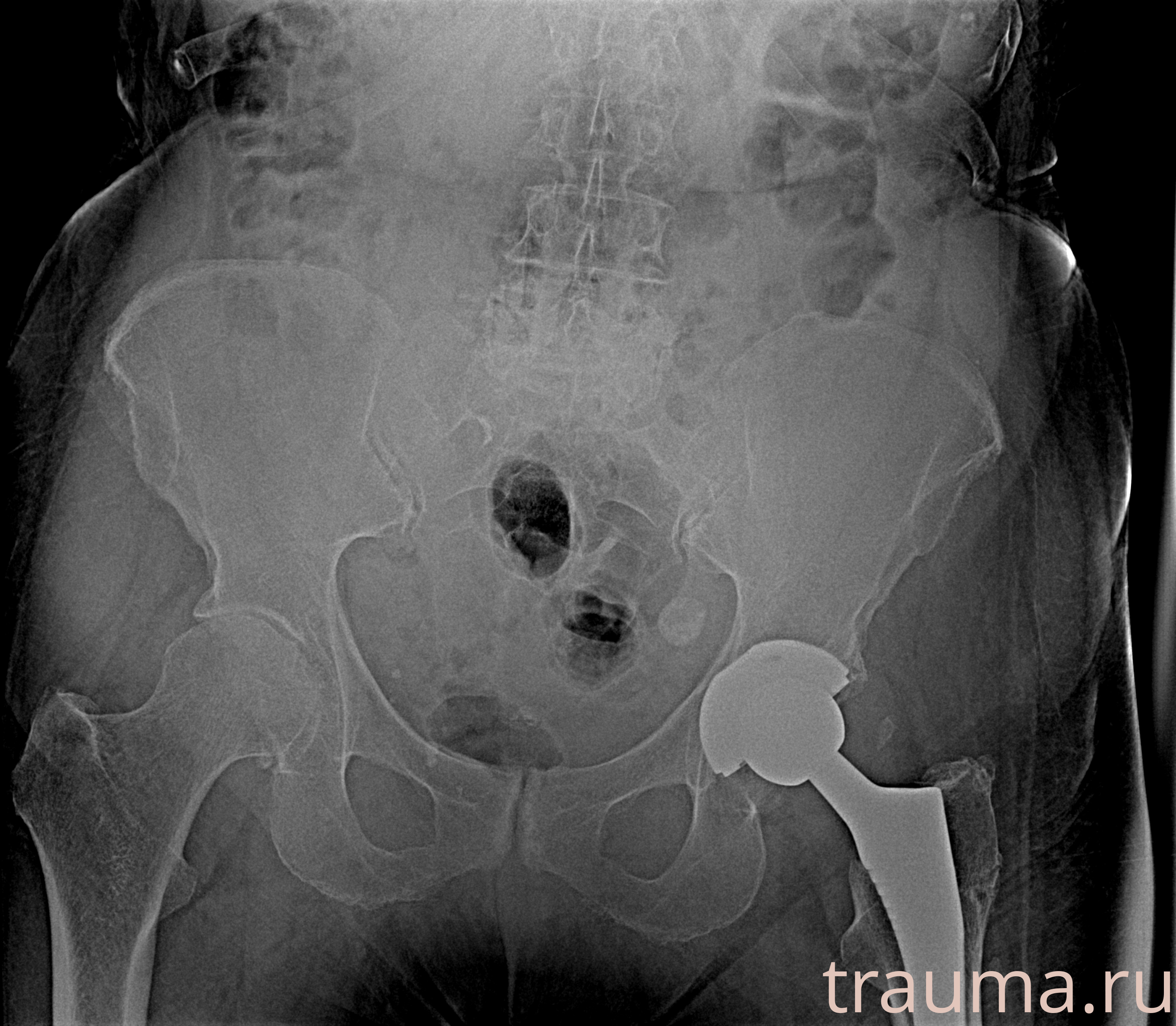 Рентген на дому: по вашему адресу приезжает врач-рентгенолог, травматолог-ортопед с мобильным рентгеновским аппаратом, проводит диагностику травмы или заболевания, делает необходимые рентгенограммы, дает рекомендации по дальнейшему лечению. Получить качественные снимки в домашних условиях возможно благодаря уникальной методике, разработанной МосРентген Центром для института  Склифосовского