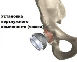Обоснование использования оригинальной классификации посттравматических деформаций вертлужной впадины при первичном эндопротезировании тазобедренного сустава Обоснование использования оригинальной классификации посттравматических деформаций вертлужной впадины при первичном эндопротезировании тазобедренного сустава