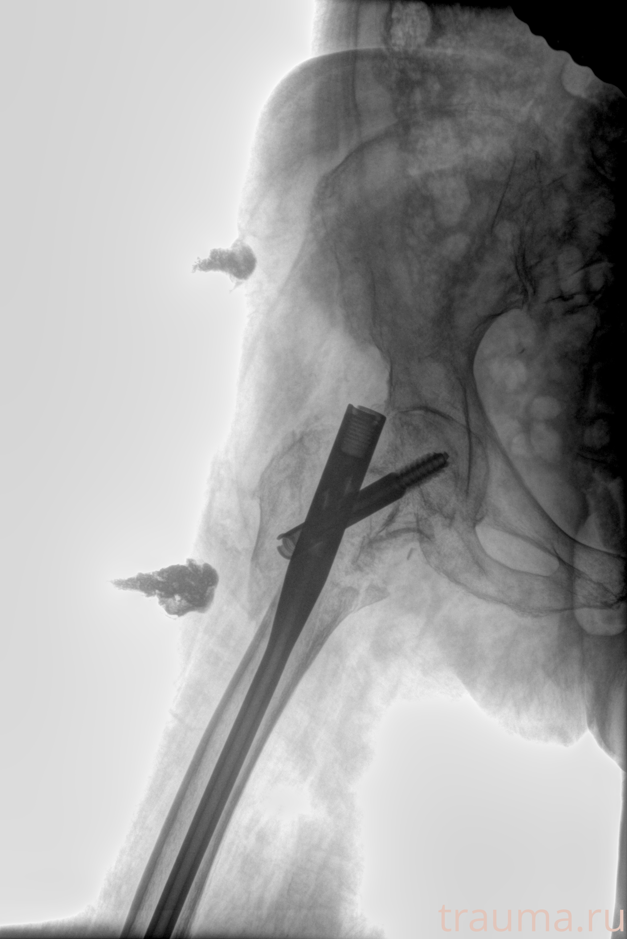 Рентген на дому: по вашему адресу приезжает врач-рентгенолог, травматолог-ортопед с мобильным рентгеновским аппаратом, проводит диагностику травмы или заболевания, делает необходимые рентгенограммы, дает рекомендации по дальнейшему лечению. Получить качественные снимки в домашних условиях возможно благодаря уникальной методике, разработанной МосРентген Центром для института  Склифосовского