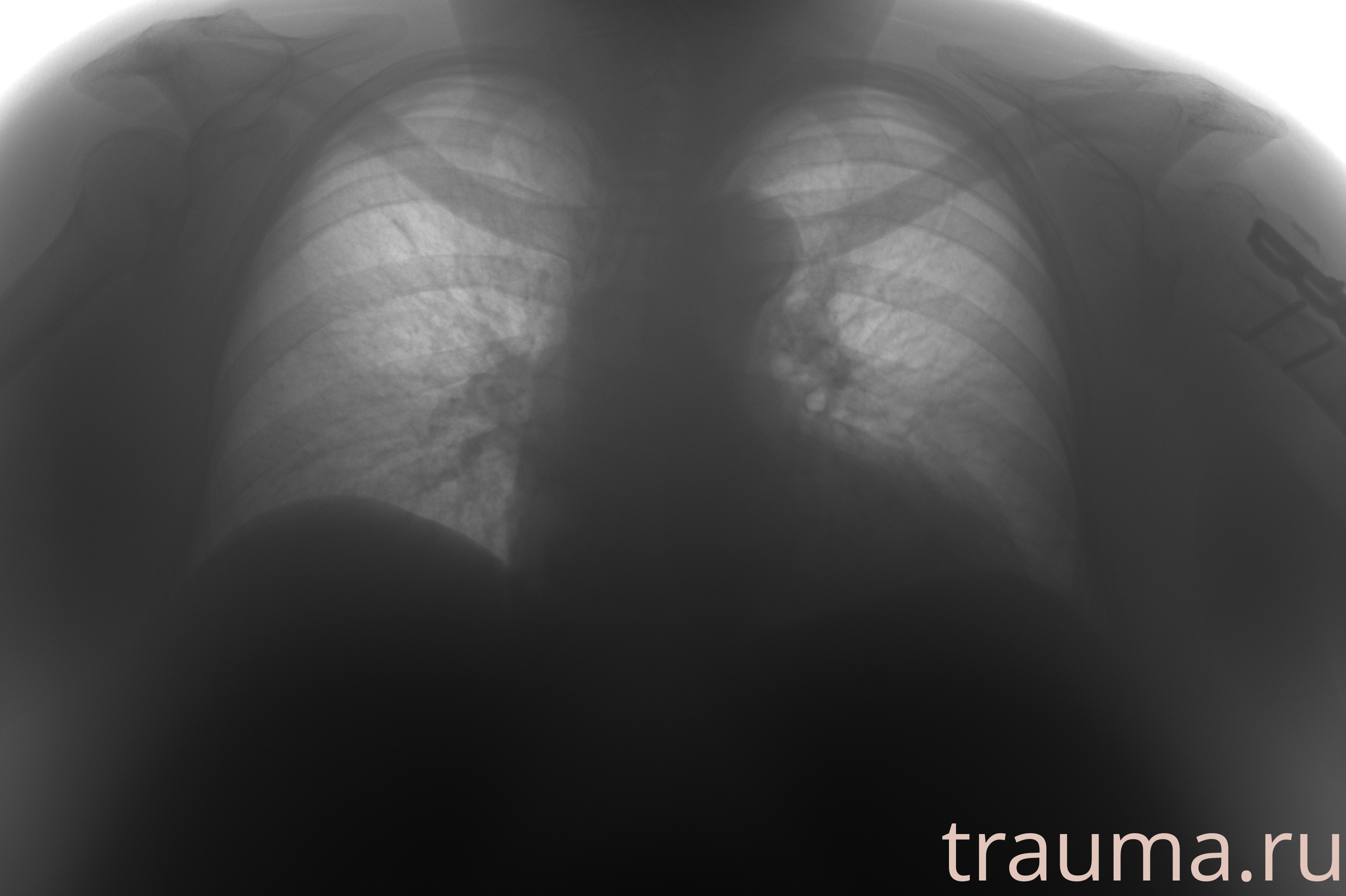 Рентген на дому: по вашему адресу приезжает врач-рентгенолог, травматолог-ортопед с мобильным рентгеновским аппаратом, проводит диагностику травмы или заболевания, делает необходимые рентгенограммы, дает рекомендации по дальнейшему лечению. Получить качественные снимки в домашних условиях возможно благодаря уникальной методике, разработанной МосРентген Центром для института  Склифосовского