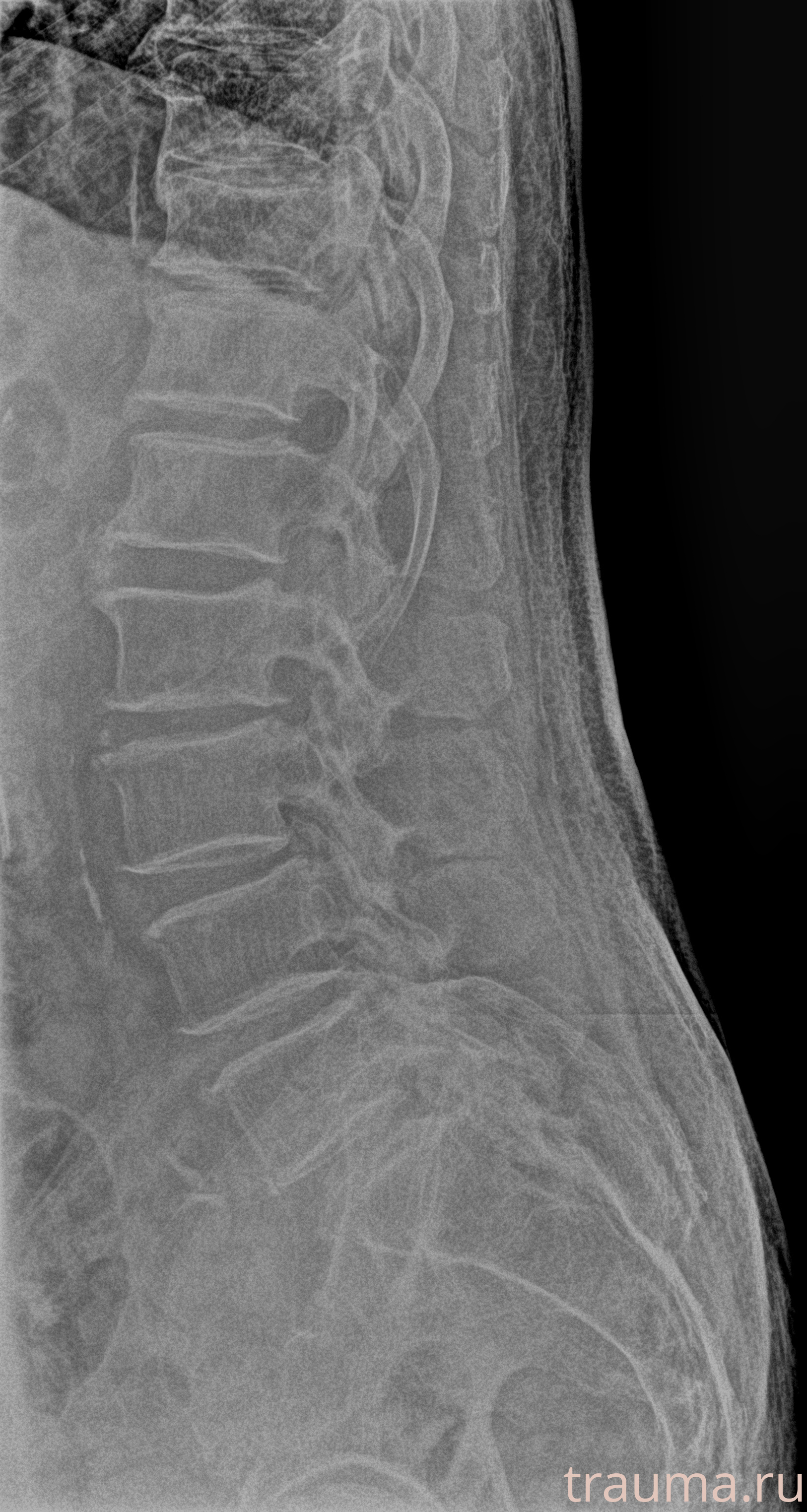 Рентген на дому: по вашему адресу приезжает врач-рентгенолог, травматолог-ортопед с мобильным рентгеновским аппаратом, проводит диагностику травмы или заболевания, делает необходимые рентгенограммы, дает рекомендации по дальнейшему лечению. Получить качественные снимки в домашних условиях возможно благодаря уникальной методике, разработанной МосРентген Центром для института  Склифосовского