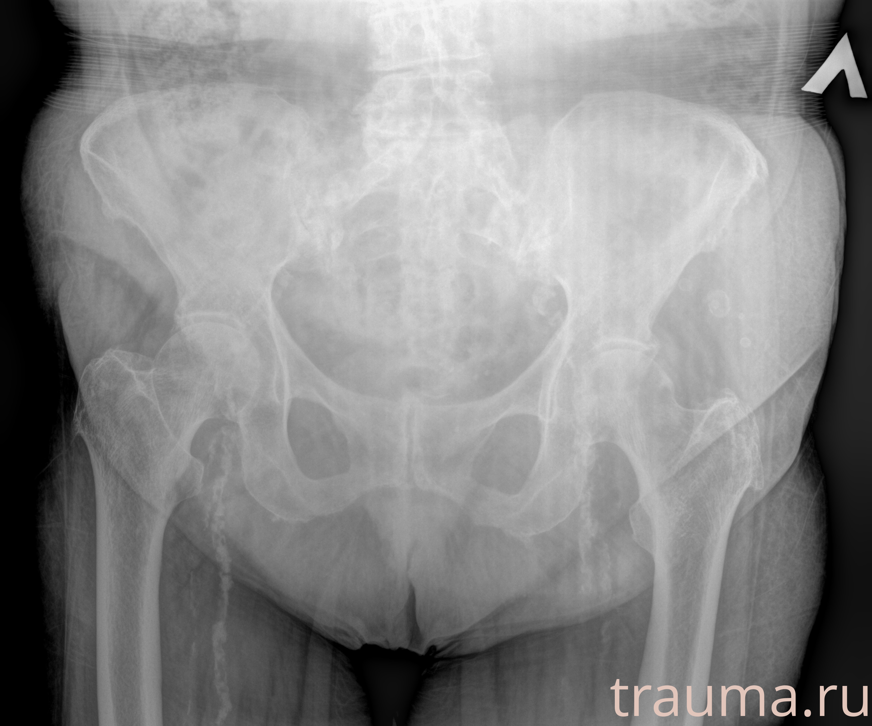 Рентген на дому: по вашему адресу приезжает врач-рентгенолог, травматолог-ортопед с мобильным рентгеновским аппаратом, проводит диагностику травмы или заболевания, делает необходимые рентгенограммы, дает рекомендации по дальнейшему лечению. Получить качественные снимки в домашних условиях возможно благодаря уникальной методике, разработанной МосРентген Центром для института  Склифосовского