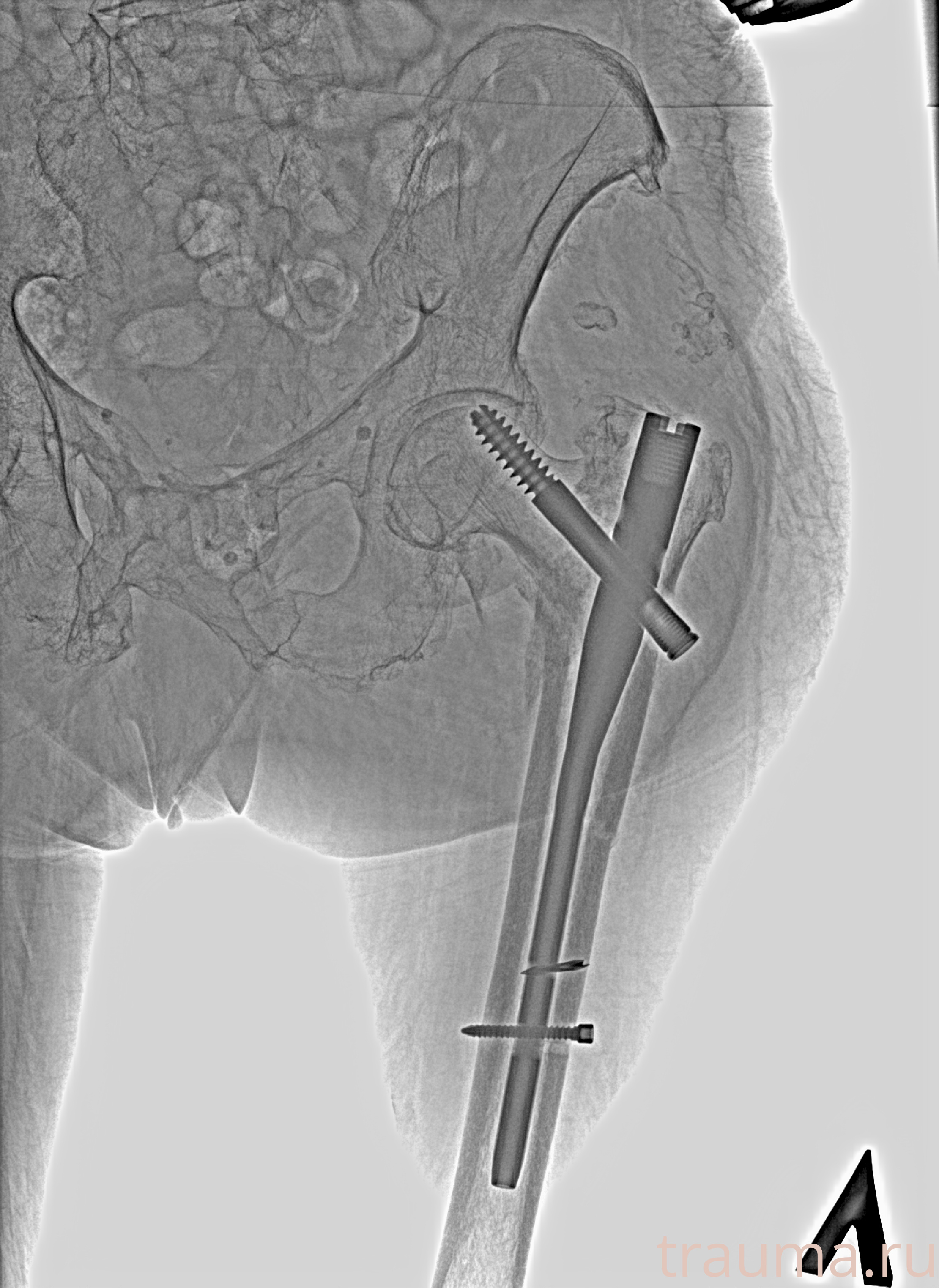 Рентген на дому: по вашему адресу приезжает врач-рентгенолог, травматолог-ортопед с мобильным рентгеновским аппаратом, проводит диагностику травмы или заболевания, делает необходимые рентгенограммы, дает рекомендации по дальнейшему лечению. Получить качественные снимки в домашних условиях возможно благодаря уникальной методике, разработанной МосРентген Центром для института  Склифосовского