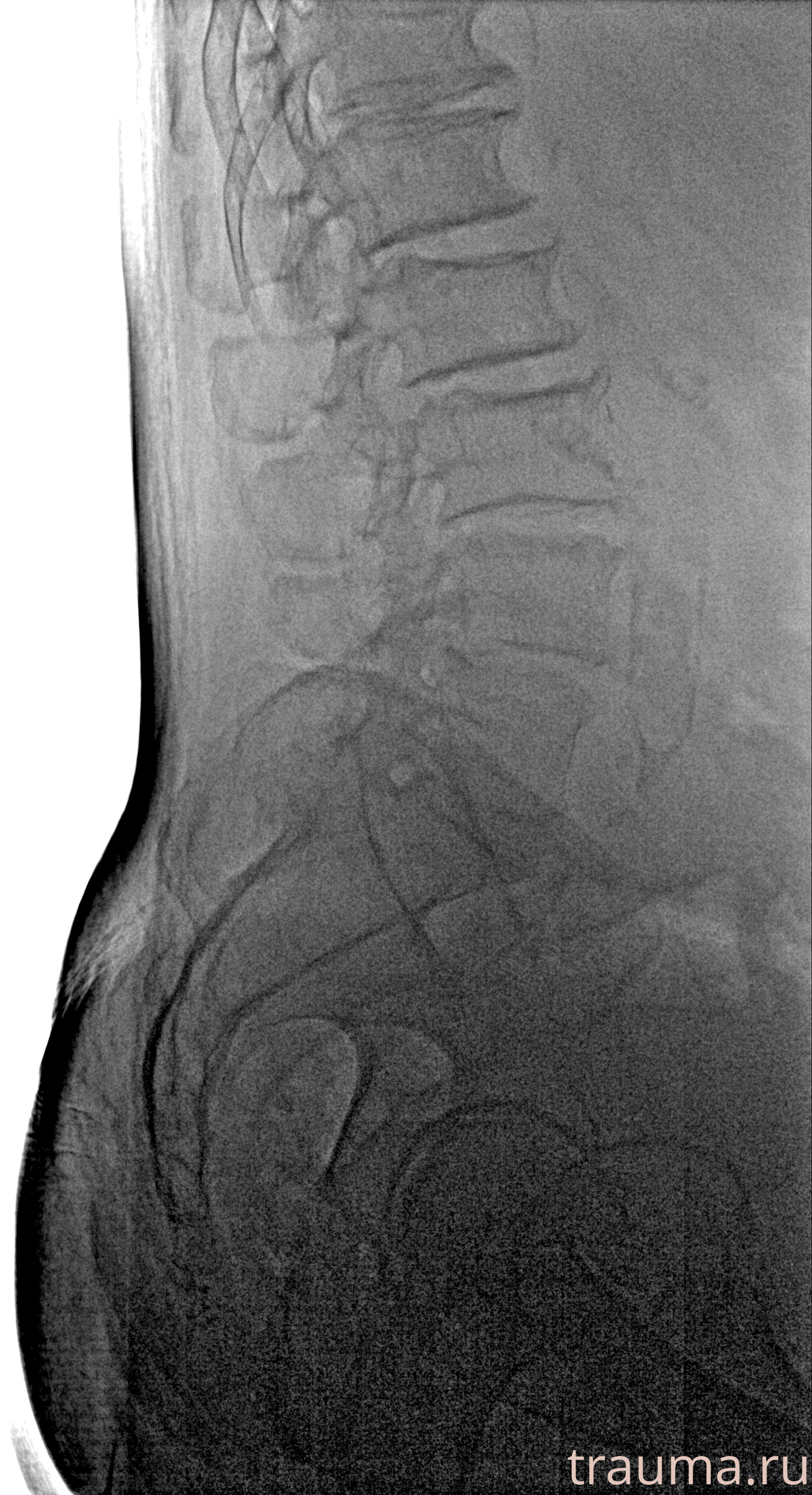 Рентген на дому: по вашему адресу приезжает врач-рентгенолог, травматолог-ортопед с мобильным рентгеновским аппаратом, проводит диагностику травмы или заболевания, делает необходимые рентгенограммы, дает рекомендации по дальнейшему лечению. Получить качественные снимки в домашних условиях возможно благодаря уникальной методике, разработанной МосРентген Центром для института  Склифосовского