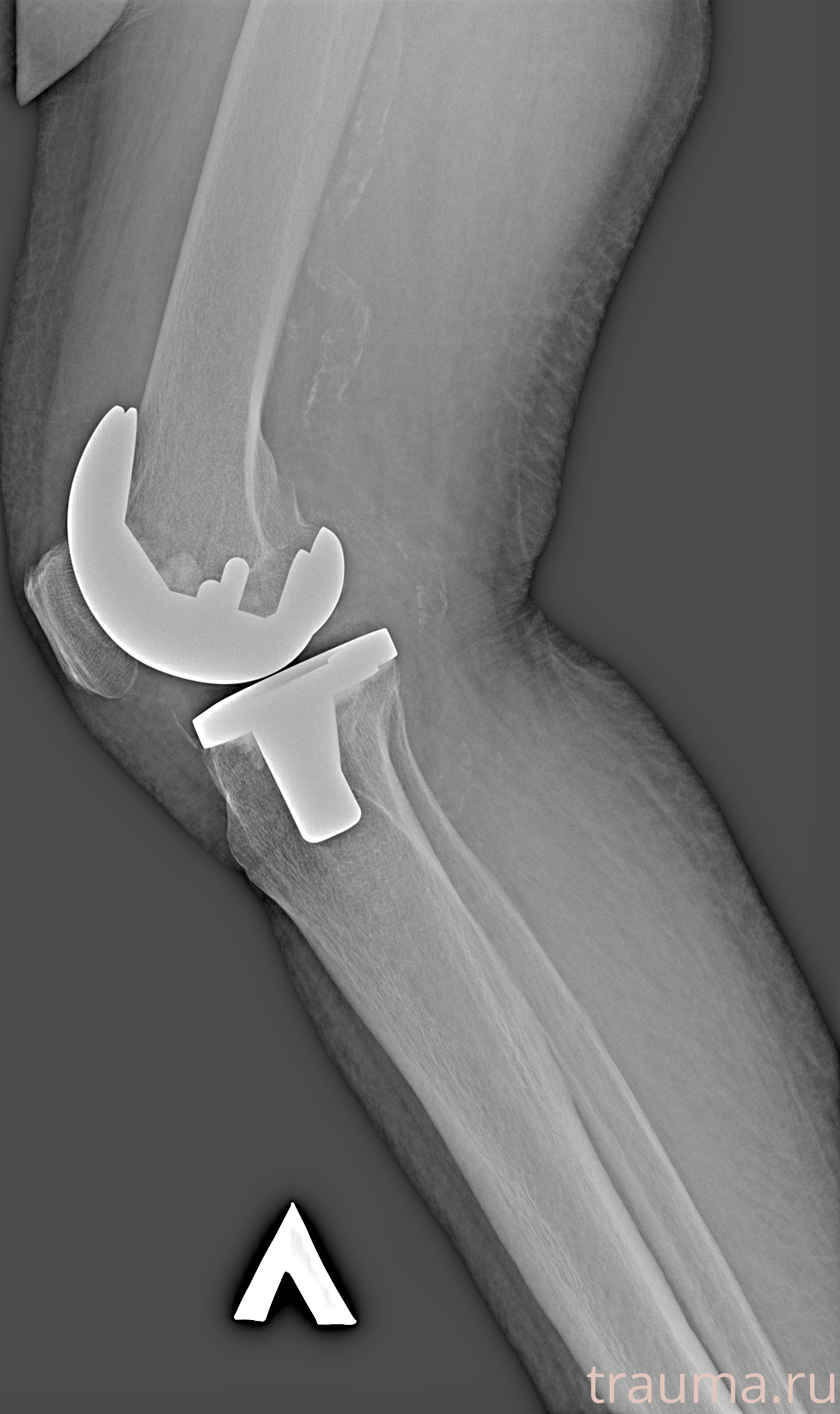 Рентген на дому: по вашему адресу приезжает врач-рентгенолог, травматолог-ортопед с мобильным рентгеновским аппаратом, проводит диагностику травмы или заболевания, делает необходимые рентгенограммы, дает рекомендации по дальнейшему лечению. Получить качественные снимки в домашних условиях возможно благодаря уникальной методике, разработанной МосРентген Центром для института  Склифосовского