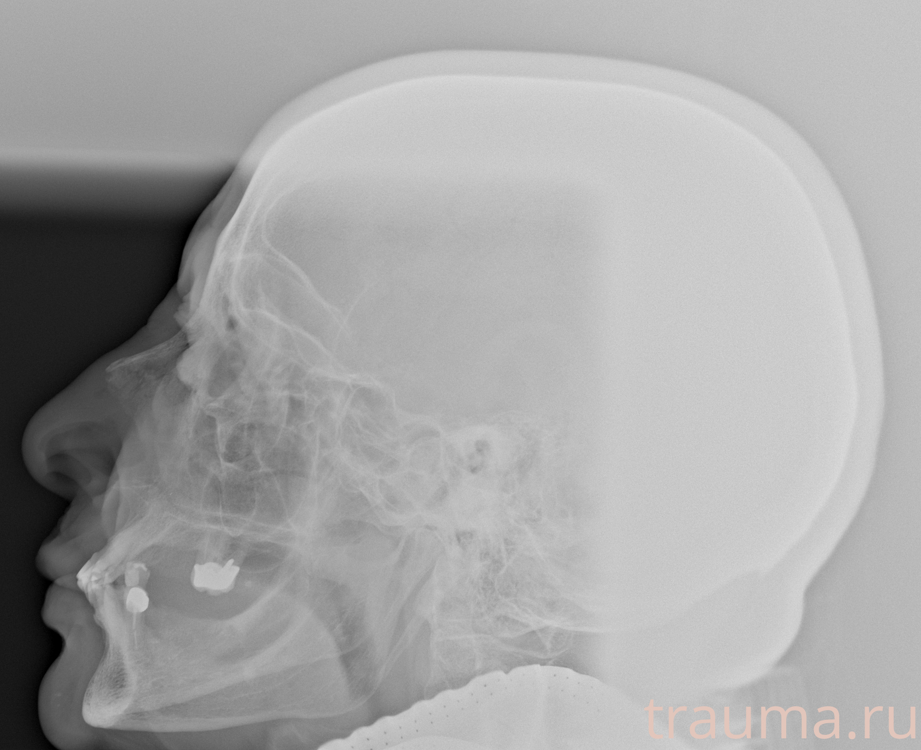 Рентген на дому: по вашему адресу приезжает врач-рентгенолог, травматолог-ортопед с мобильным рентгеновским аппаратом, проводит диагностику травмы или заболевания, делает необходимые рентгенограммы, дает рекомендации по дальнейшему лечению. Получить качественные снимки в домашних условиях возможно благодаря уникальной методике, разработанной МосРентген Центром для института  Склифосовского